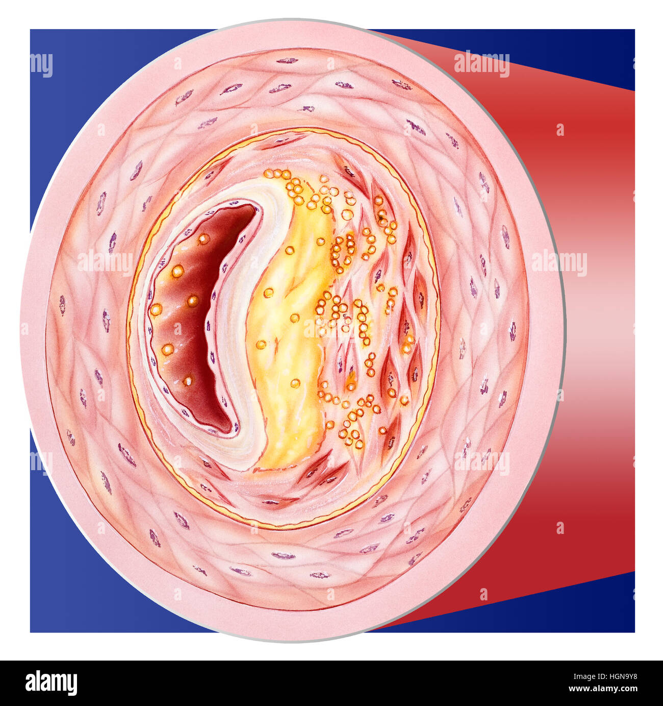 'Ostruzione di un vaso sanguigno, sezione che mostra la placca aterosclerotica accumulo Foto Stock