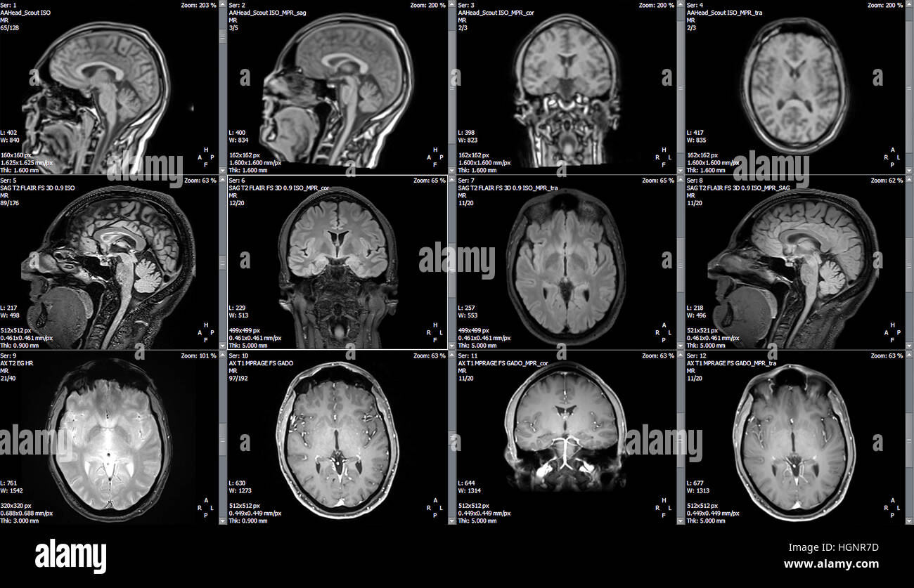 Immagini a risonanza magnetica (MRI) di un cervello Foto Stock