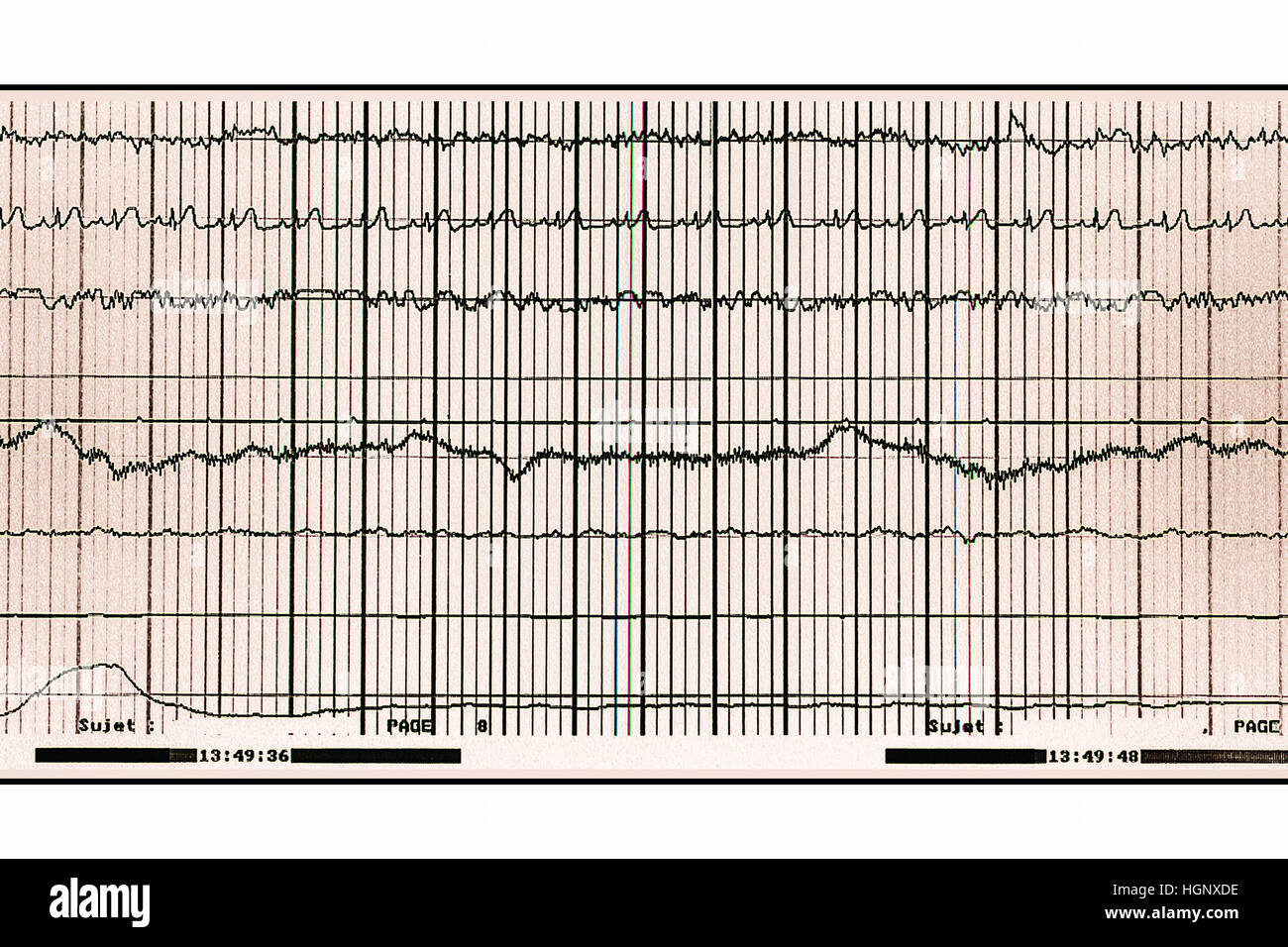 Sindrome da apnea del sonno immagini e fotografie stock ad alta