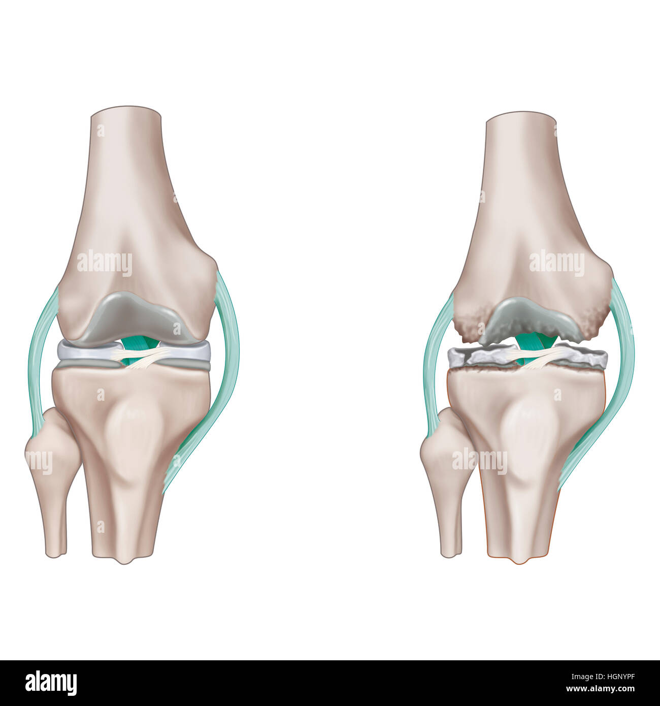 Osteoartrite DEL GINOCCHIO, illustrazione Foto Stock