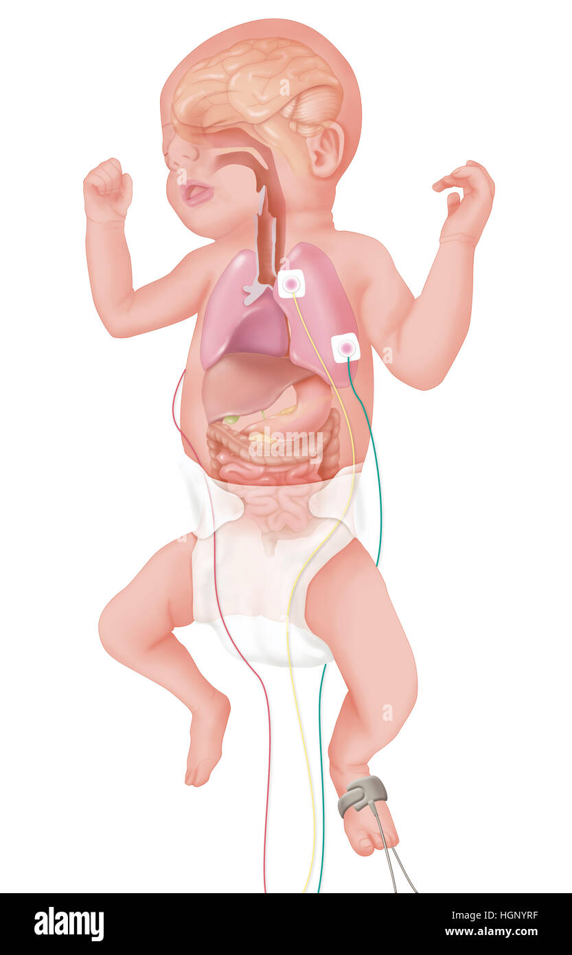 Bambino prematuro, illustrazione Foto Stock