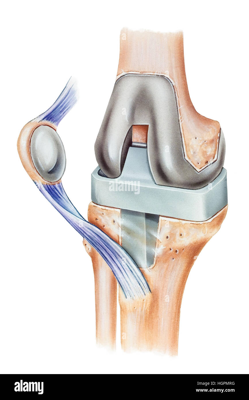 Illustrazione di una sostituzione totale del ginocchio, che mostra una protesi  rotuleo, una sezione trasversale della rotula con la sostituzione rotuleo  cementato nel plac Foto stock - Alamy