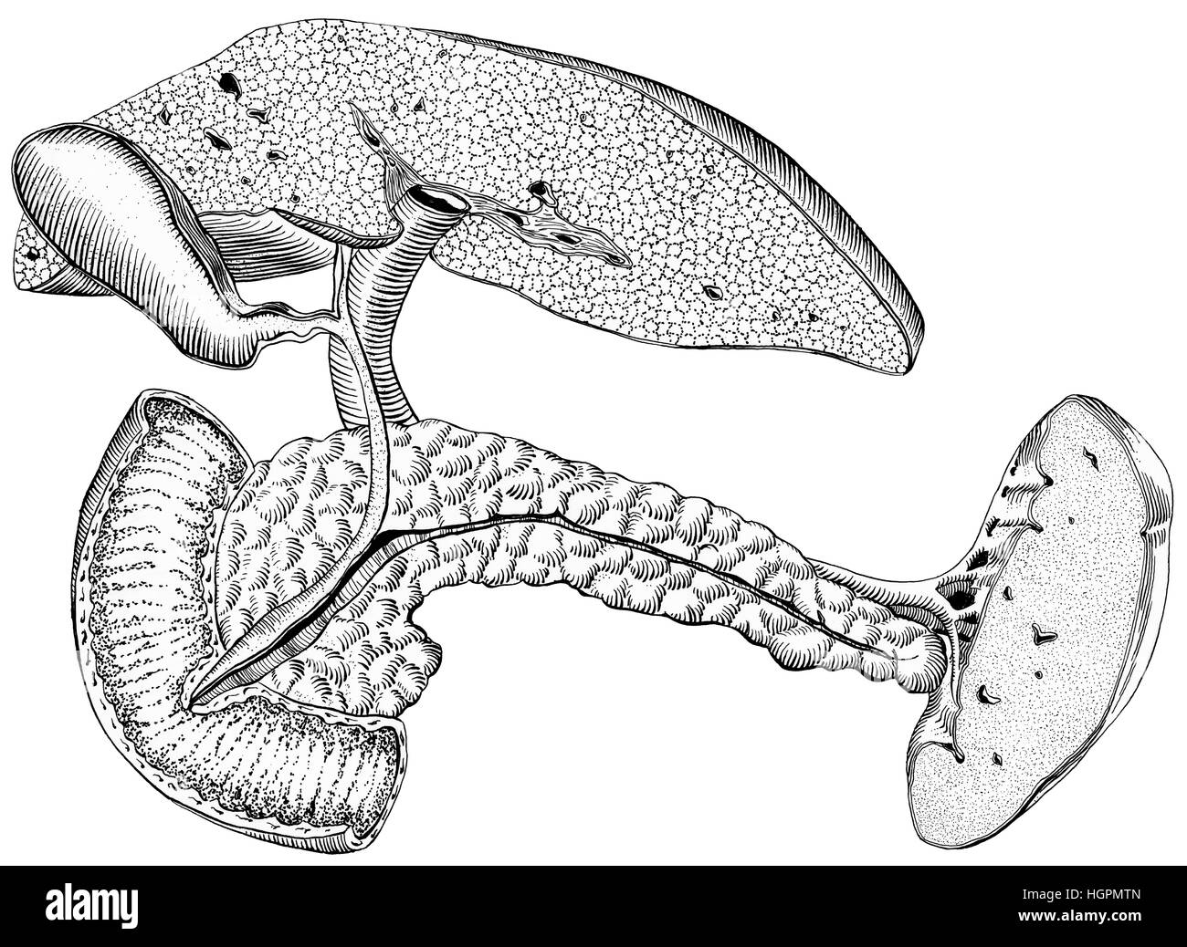 Fegato - cirrosi. Sono illustrate anche la cistifellea, pancreas, milza, duetto di intestino. Foto Stock