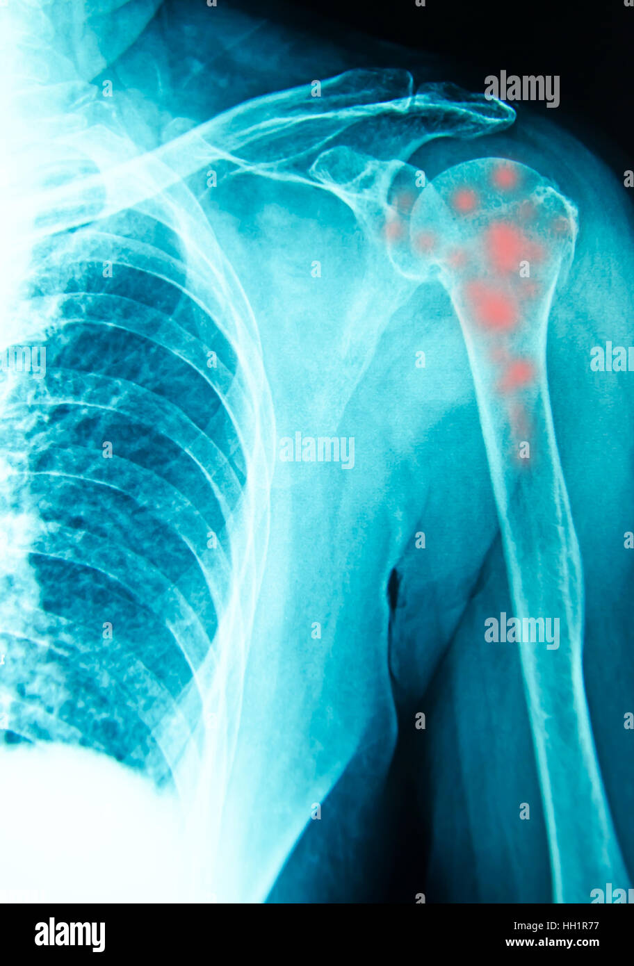 Spalla raggi x per la diagnosi con osso inflamatory Foto Stock