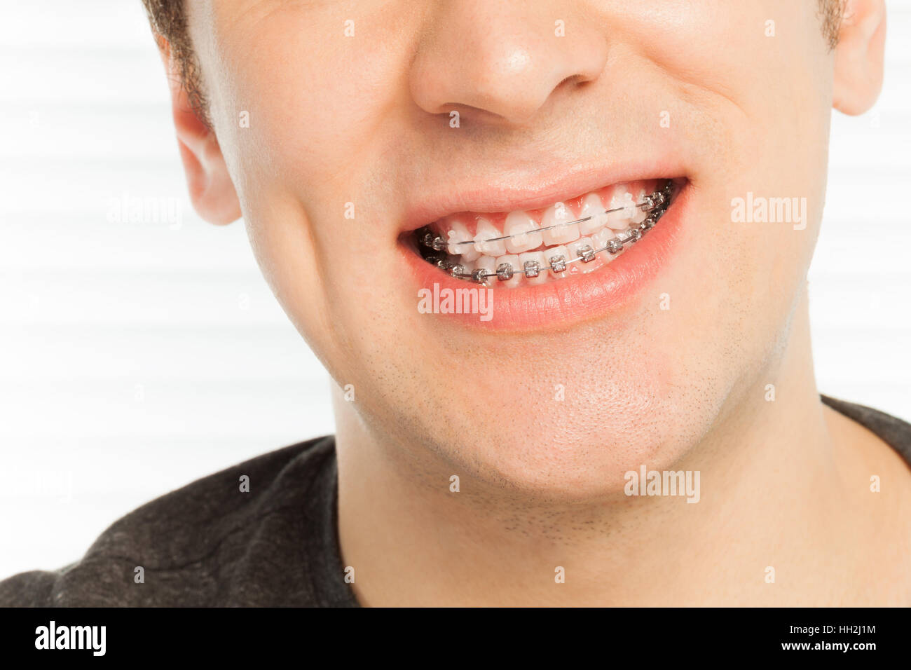 Uomo felice il sorriso con casi ortodontico Foto Stock