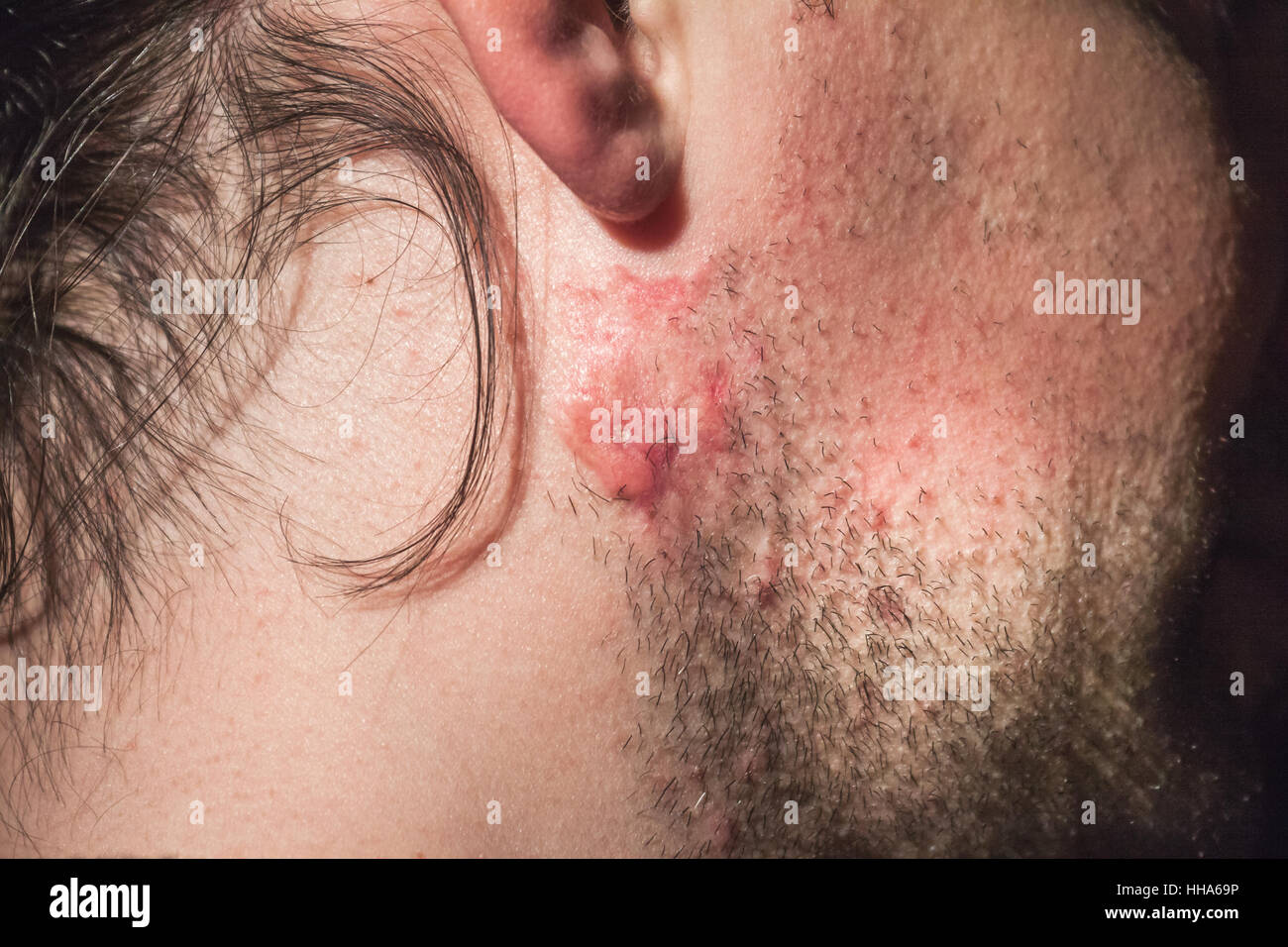 Il cancro della pelle vicino fino sulla guancia uomo Foto Stock