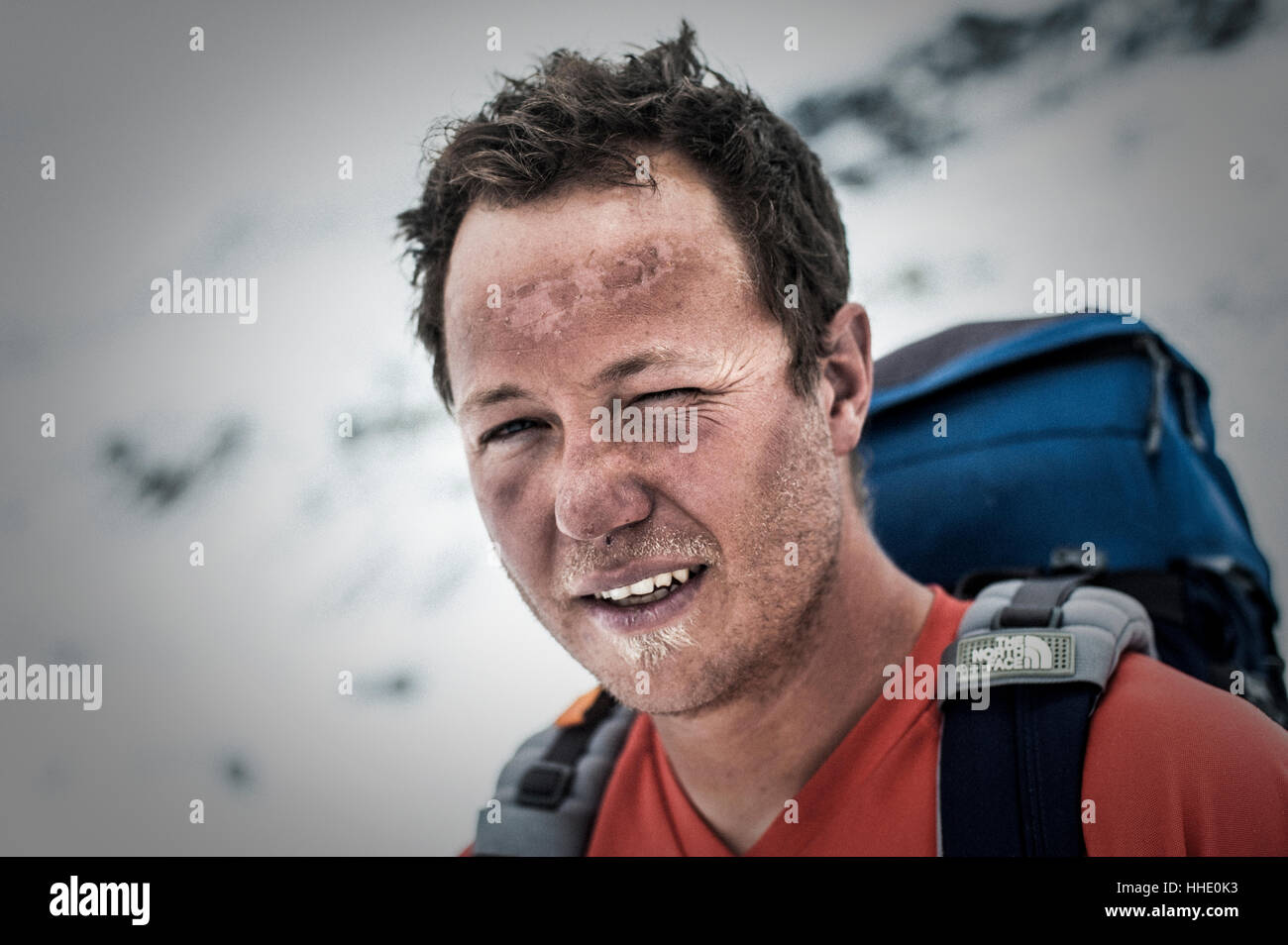 Un scalatore al Campo Base Everest mostra segni di esposizione ad alta altitudine, Regione di Khumbu, in Nepal Foto Stock