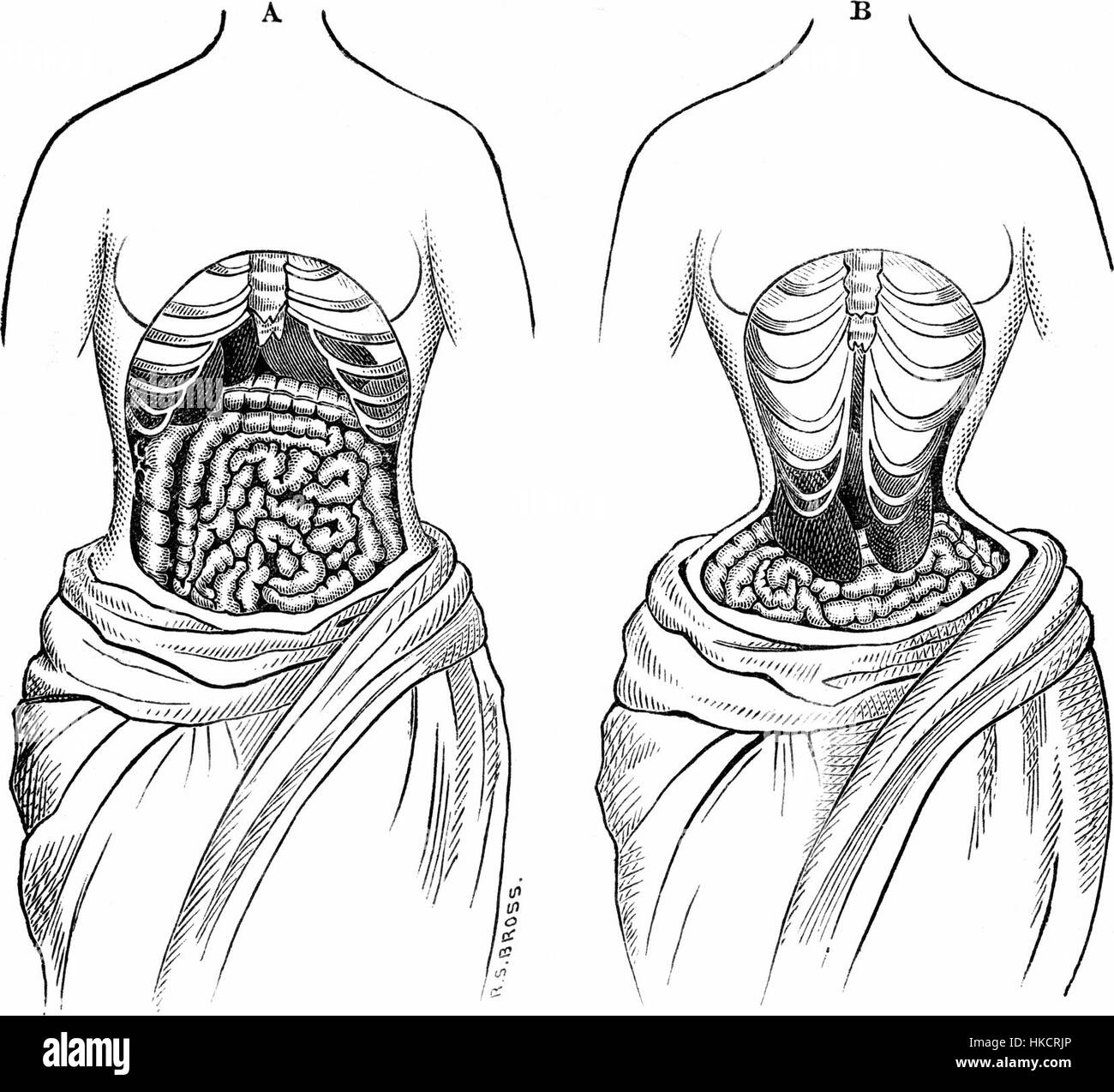 Questa opera d'arte esplora il concetto di "allacciatura stretta", una pratica di corsetteria estrema comune nel XIX secolo. Il dipinto trasmette la natura restrittiva della moda, riflettendo il suo significato sociale e culturale durante quel periodo. Foto Stock
