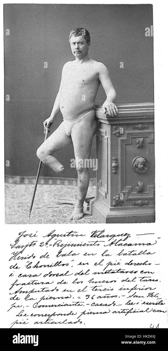 "Mutilado en la GDP 61" è un'opera d'arte che esplora visivamente il tema degli infortuni e della lotta. Il pezzo raffigura una figura in difficoltà, che riflette il tributo emotivo e fisico di tali esperienze. Si tratta di una potente rappresentazione della vulnerabilità umana e della resilienza. Foto Stock