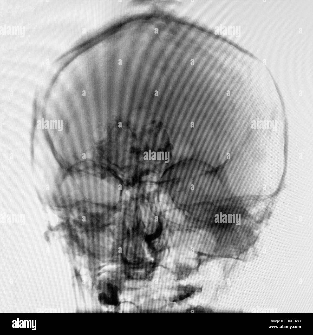 Testa umana X-ray immagine sul monitor di un computer in una nuova sala di neurochirurgia in un moderno ospedale specializzato nel trattamento delle malattie cerebrovascolari. Hum Foto Stock