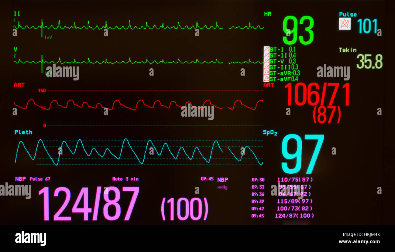 Monitor con schermo nero mostra EKG con flutter atriale su linee verde, pressione arteriosa sulla linea rossa e della saturazione di ossigeno sulla linea blu, Foto Stock