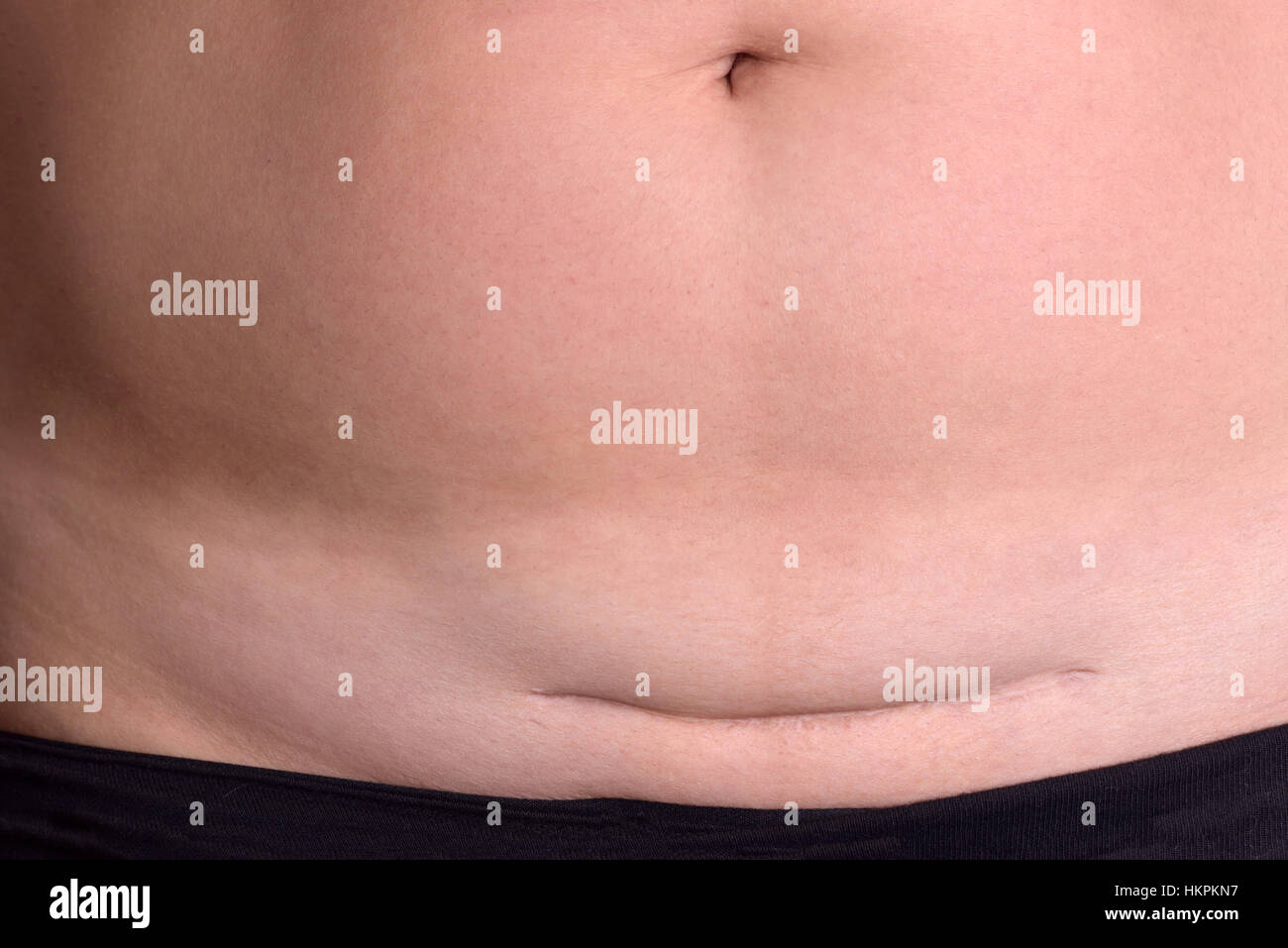 Primo piano della donna ventre con una cicatrice da un parto cesareo Foto Stock