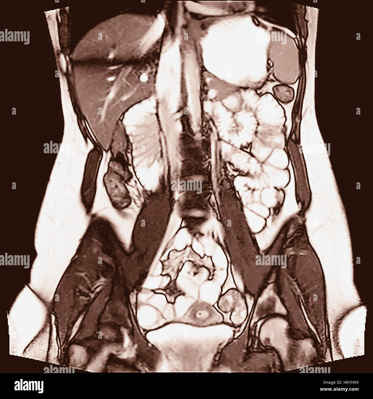 Enterography chiamato anche un studio gastrointestinale o contrasto radiografia del tratto gastrointestinale, è una serie di radiografie utilizzato per esaminare il t Foto Stock