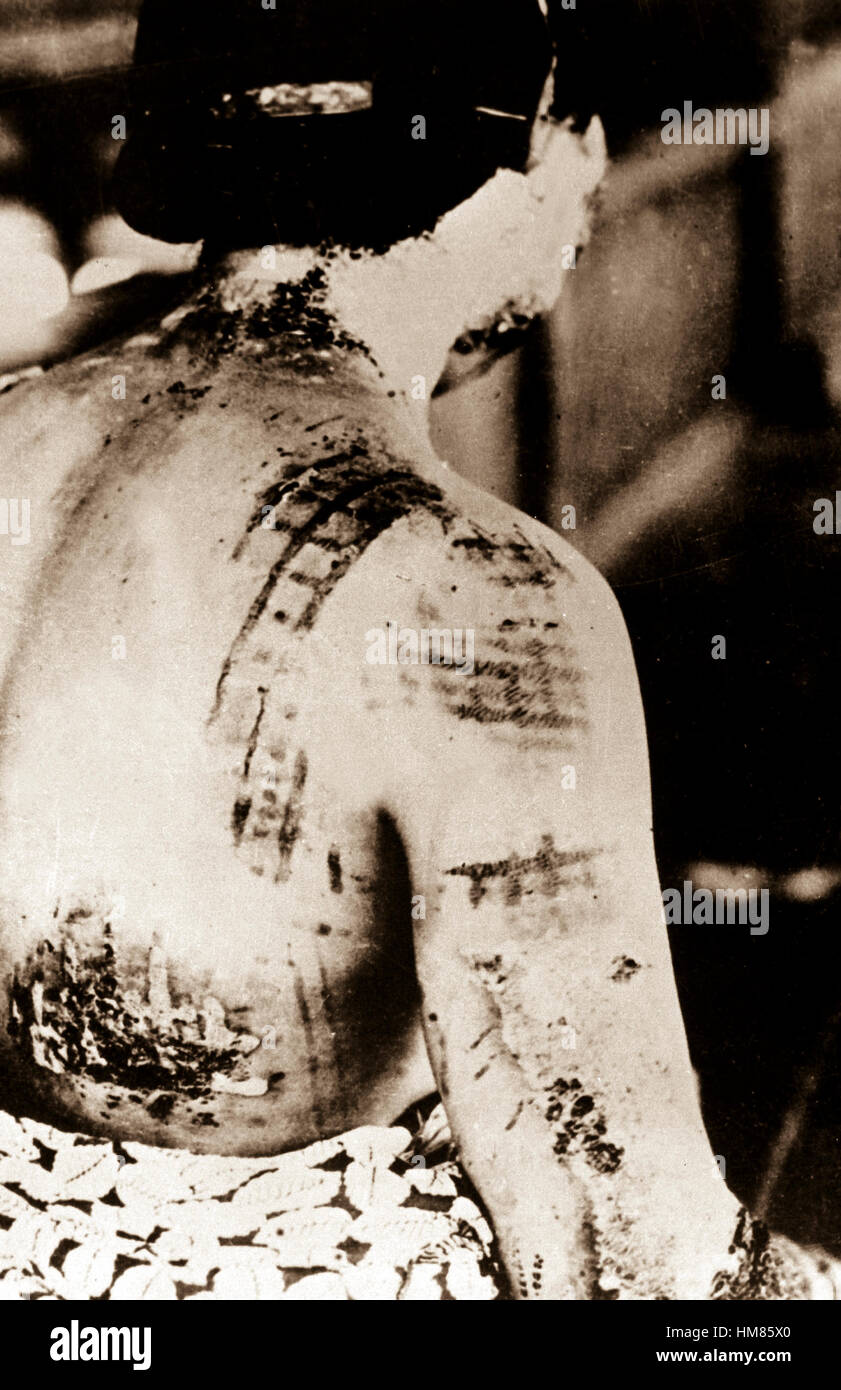 La pelle del paziente viene bruciato in una configurazione corrispondente alle porzioni scure di un kimono indossato al momento dell'esplosione. Giappone, ca. 1945. (Corpo degli Ingegneri) Data esatta Shot NARA sconosciuto file #: 077-MDH-6.55b guerra & CONFLITTO PRENOTA #: 1244 Foto Stock
