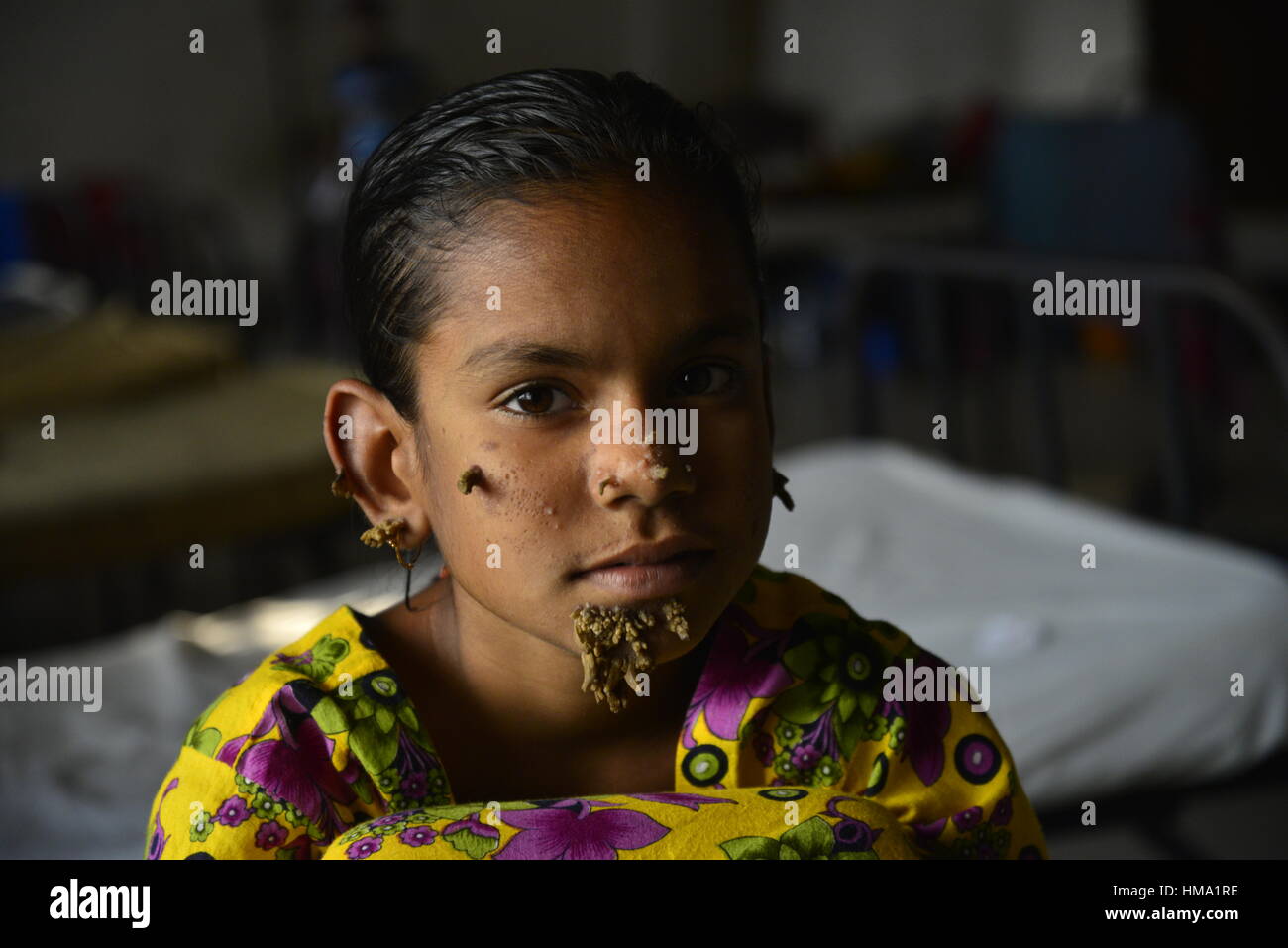 Paziente del Bangladesh Sahana Khatun, 10, in posa per una fotografia a Dhaka Medical College e ospedale. Il 1 febbraio 2017 una giovane ragazza del Bangladesh con corteccia-come le verruche crescente sul suo viso potrebbe essere la prima donna sempre afflitto da cosiddetti "tree sindrome uomo', i medici studiano la condizione rara detto gennaio 31. Dieci anni Khatun Sahana ha la spia crescite nodose spuntano dal suo mento, orecchio e naso, ma i medici a Dhaka Medical College Hospital sono ancora conducendo dei test per stabilire se essa ha il singolare disturbo della pelle. Foto Stock
