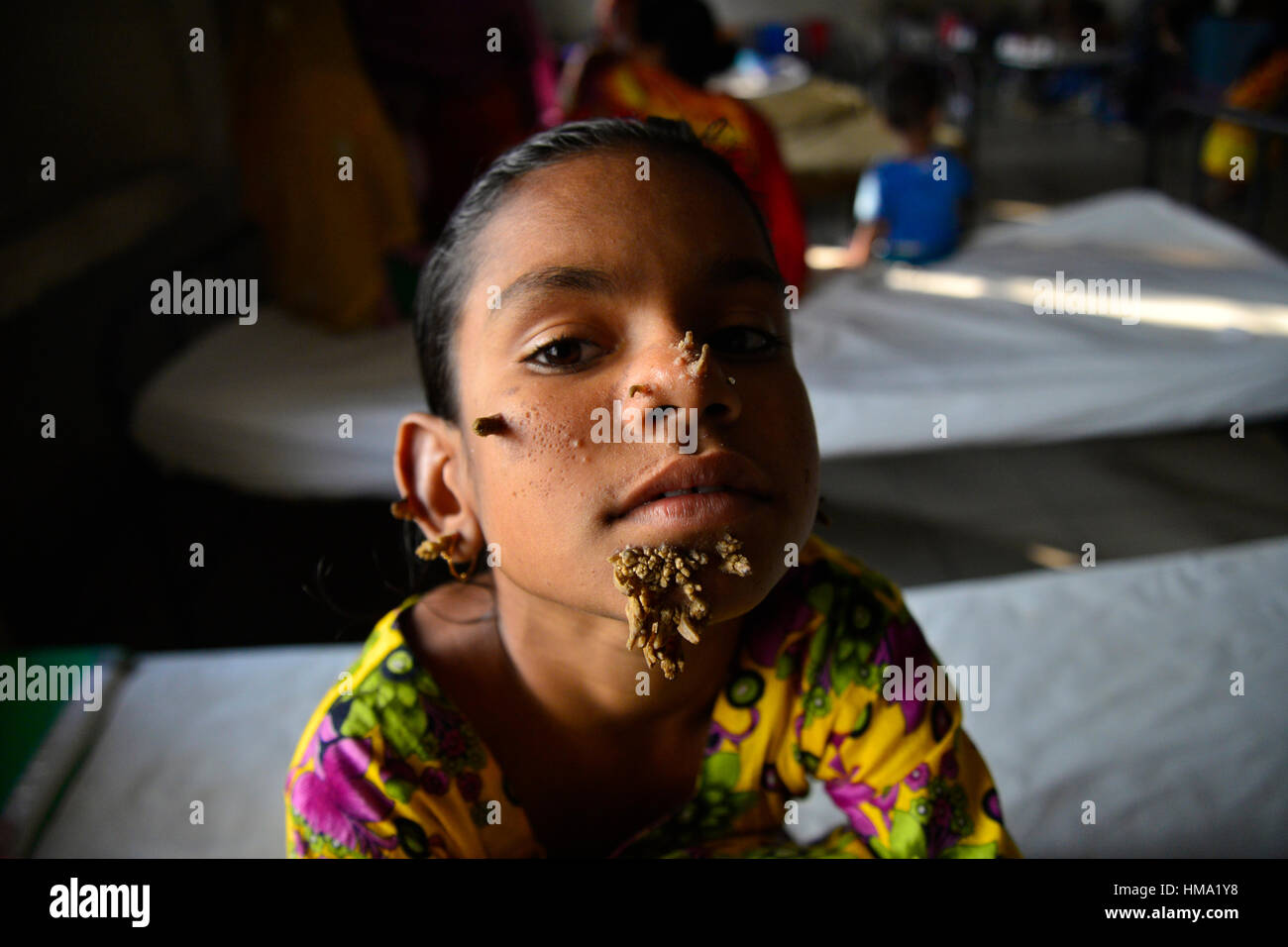 Paziente del Bangladesh Sahana Khatun, 10, in posa per una fotografia a Dhaka Medical College e ospedale. Il 1 febbraio 2017 una giovane ragazza del Bangladesh con corteccia-come le verruche crescente sul suo viso potrebbe essere la prima donna sempre afflitto da cosiddetti "tree sindrome uomo', i medici studiano la condizione rara detto gennaio 31. Dieci anni Khatun Sahana ha la spia crescite nodose spuntano dal suo mento, orecchio e naso, ma i medici a Dhaka Medical College Hospital sono ancora conducendo dei test per stabilire se essa ha il singolare disturbo della pelle. Foto Stock