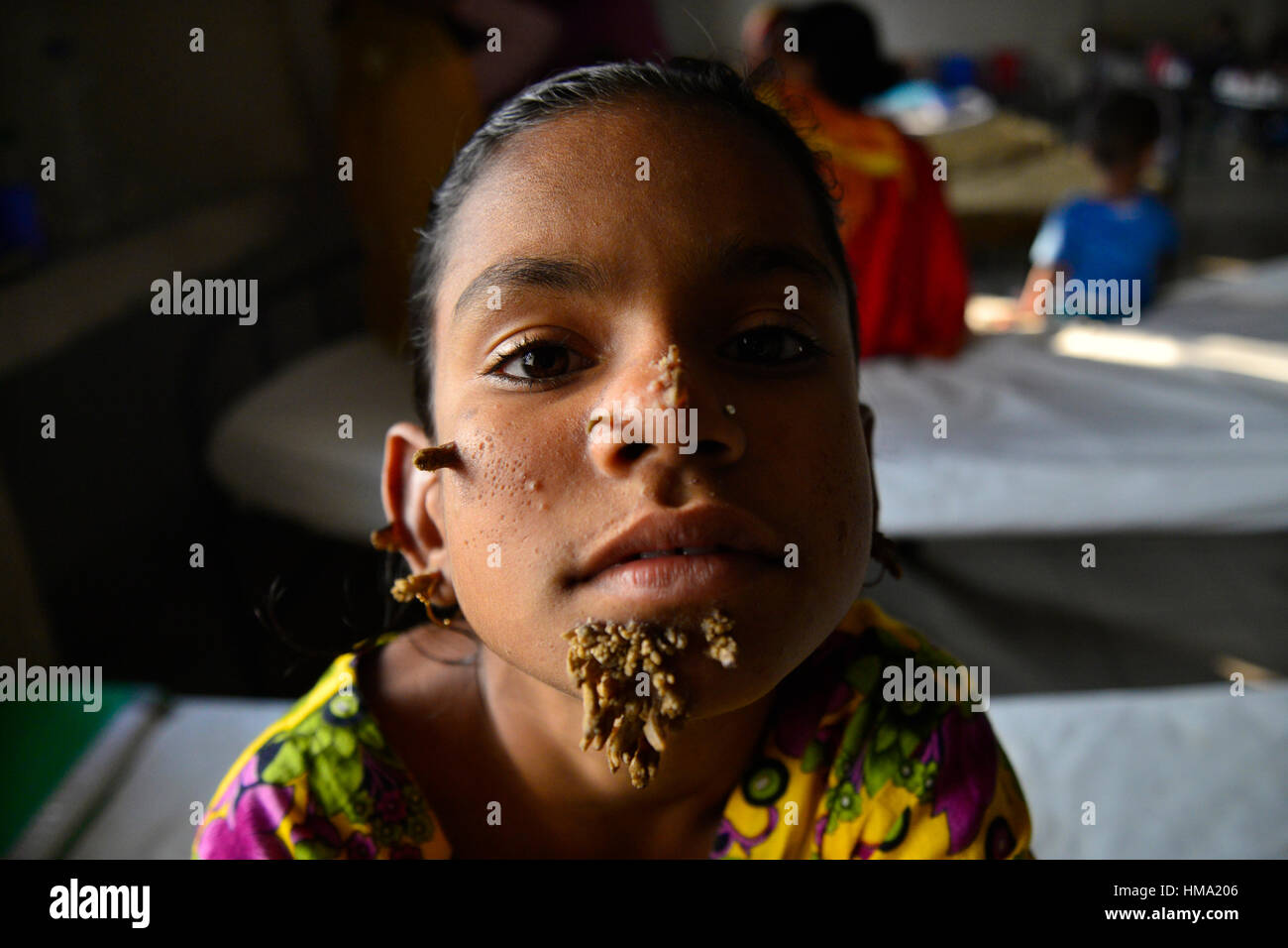 Paziente del Bangladesh Sahana Khatun, 10, in posa per una fotografia a Dhaka Medical College e ospedale. Il 1 febbraio 2017 una giovane ragazza del Bangladesh con corteccia-come le verruche crescente sul suo viso potrebbe essere la prima donna sempre afflitto da cosiddetti "tree sindrome uomo', i medici studiano la condizione rara detto gennaio 31. Dieci anni Khatun Sahana ha la spia crescite nodose spuntano dal suo mento, orecchio e naso, ma i medici a Dhaka Medical College Hospital sono ancora conducendo dei test per stabilire se essa ha il singolare disturbo della pelle. Foto Stock