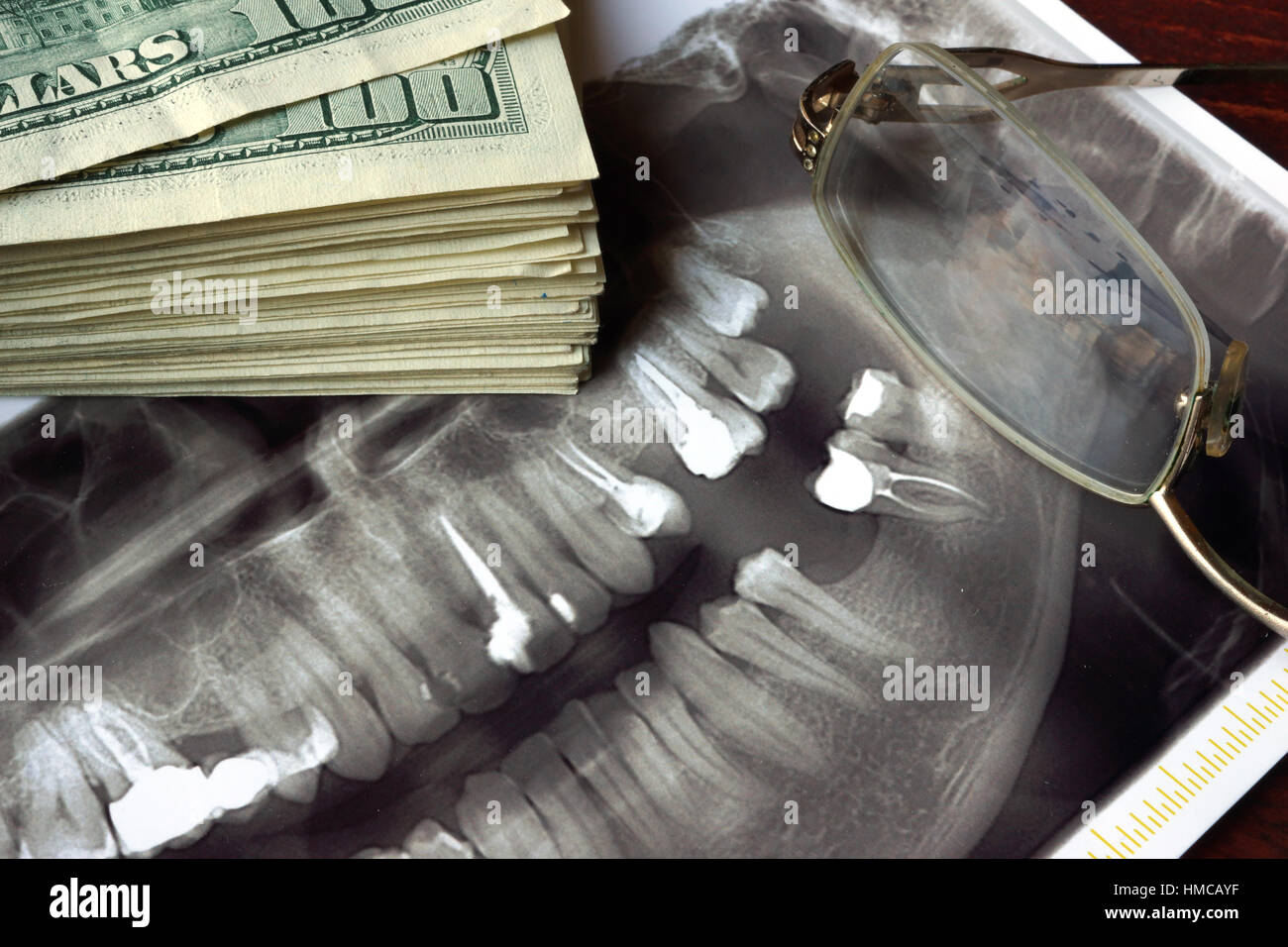 Il costo del trattamento dentale. Dentiere concetto. Foto Stock