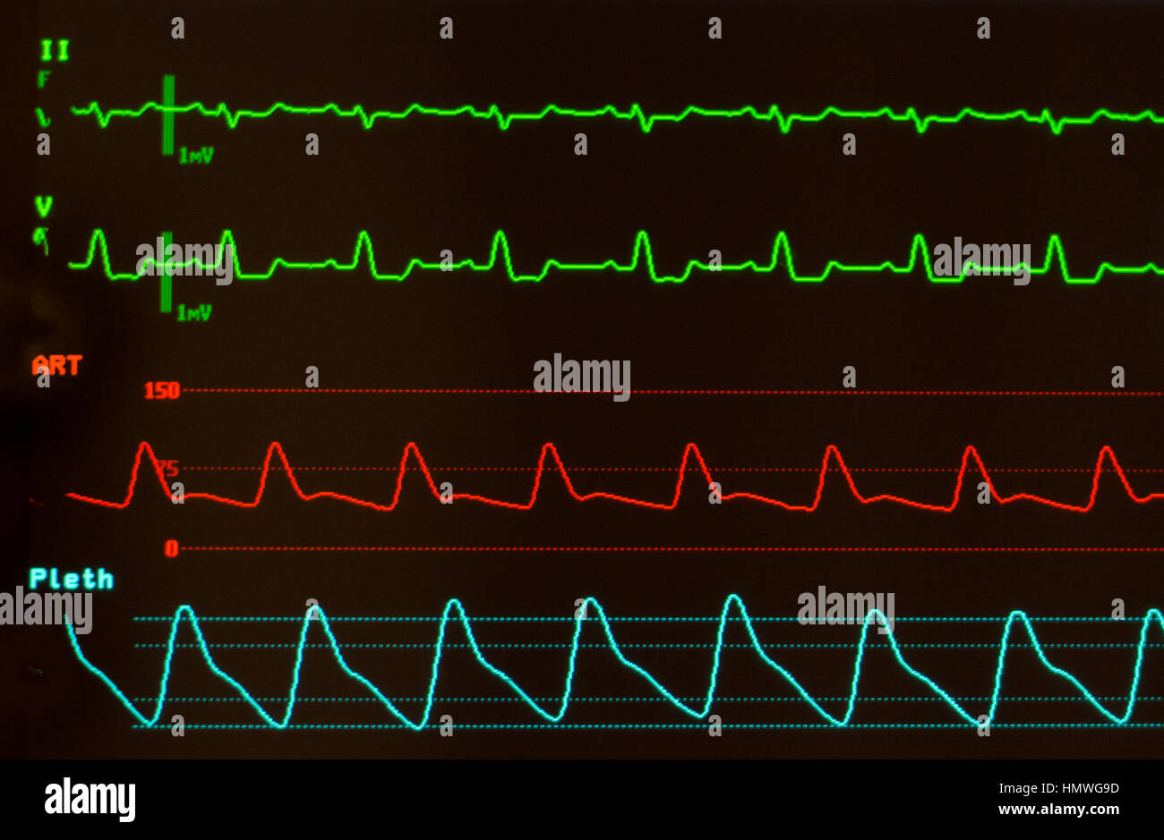 Monitor con schermo nero con ECG che mostra la conduzione intraventricolare ritardo (verdi), pressione arteriosa (rosso) e della saturazione di ossigeno (blu). Foto Stock