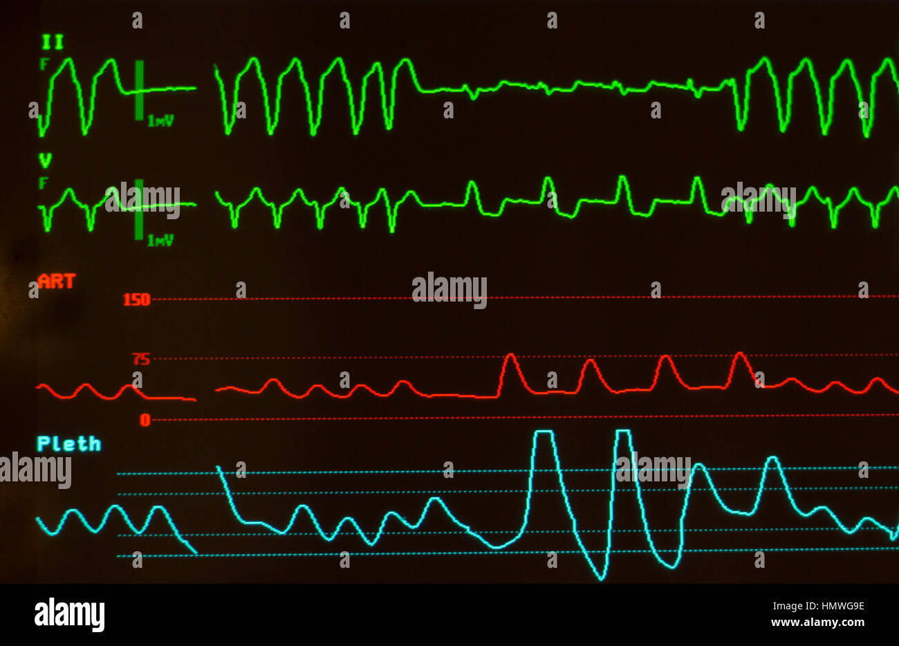 Monitor con schermo nero con ECG che mostra la conduzione intraventricolare ritardo (verdi), pressione arteriosa (rosso) e della saturazione di ossigeno (blu). Foto Stock