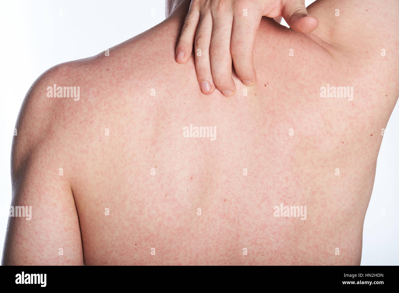 Allergy rash sul retro dell uomo isolato su bianco Foto Stock