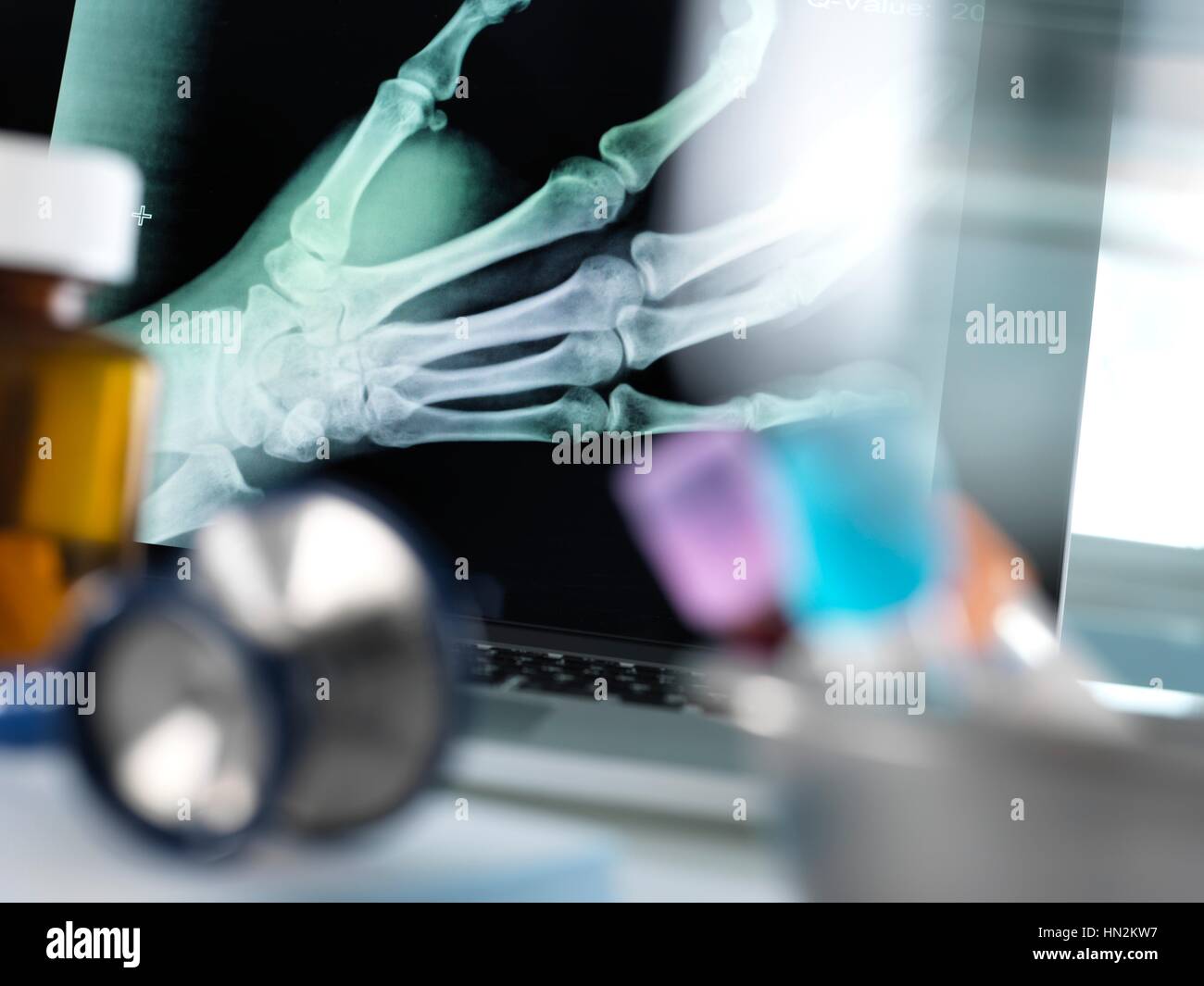 X-ray del fratturato una mano visualizzate su di uno schermo su un medico la scrivania. Foto Stock