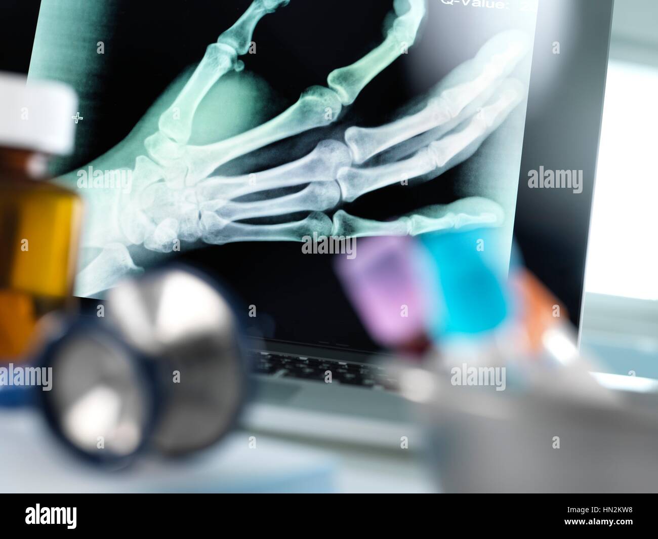 X-ray del fratturato una mano visualizzate su di uno schermo su un medico la scrivania. Foto Stock