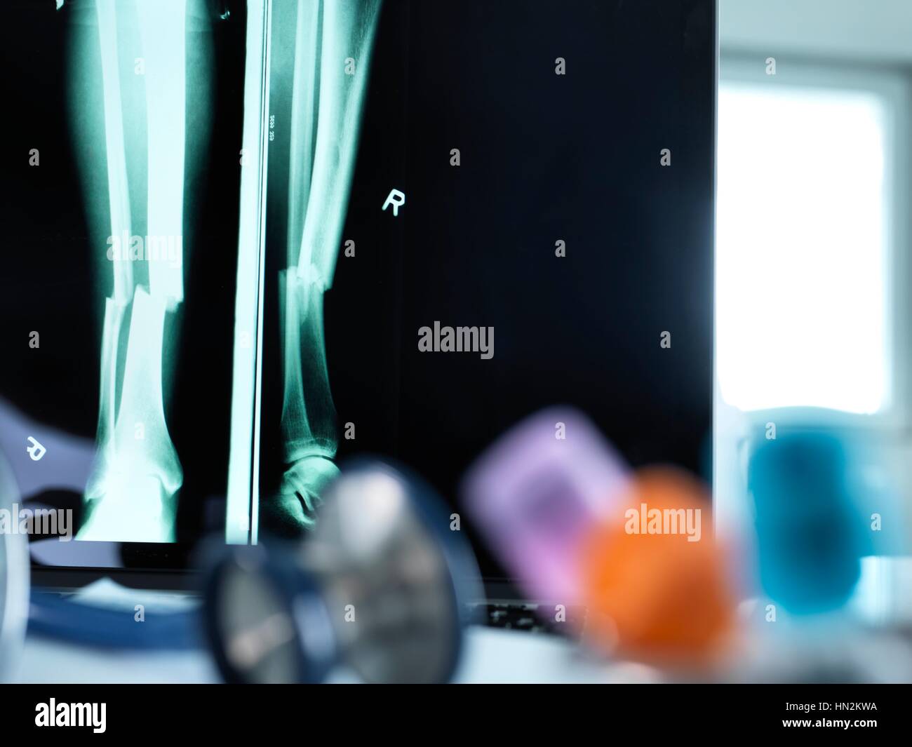 Raggi X di una gamba fratturata visualizzate su di uno schermo su un medico la scrivania. Foto Stock