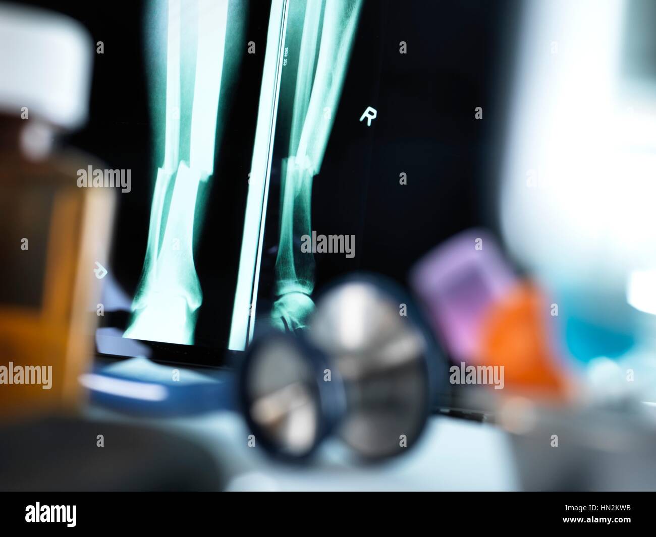 Raggi X di una gamba fratturata visualizzate su di uno schermo su un medico la scrivania. Foto Stock