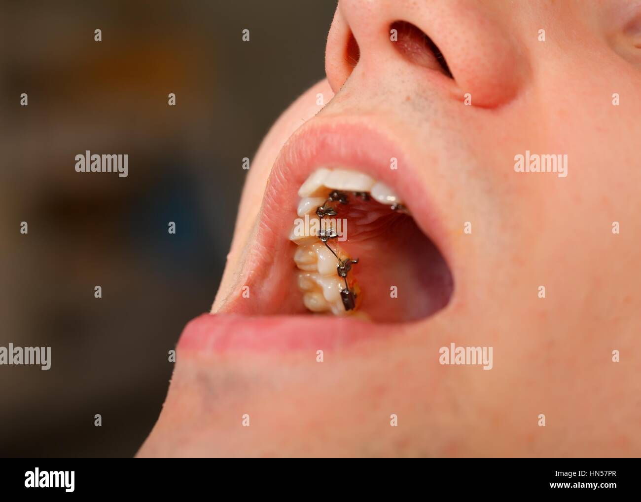 Bretelle linguali immagini e fotografie stock ad alta risoluzione - Alamy