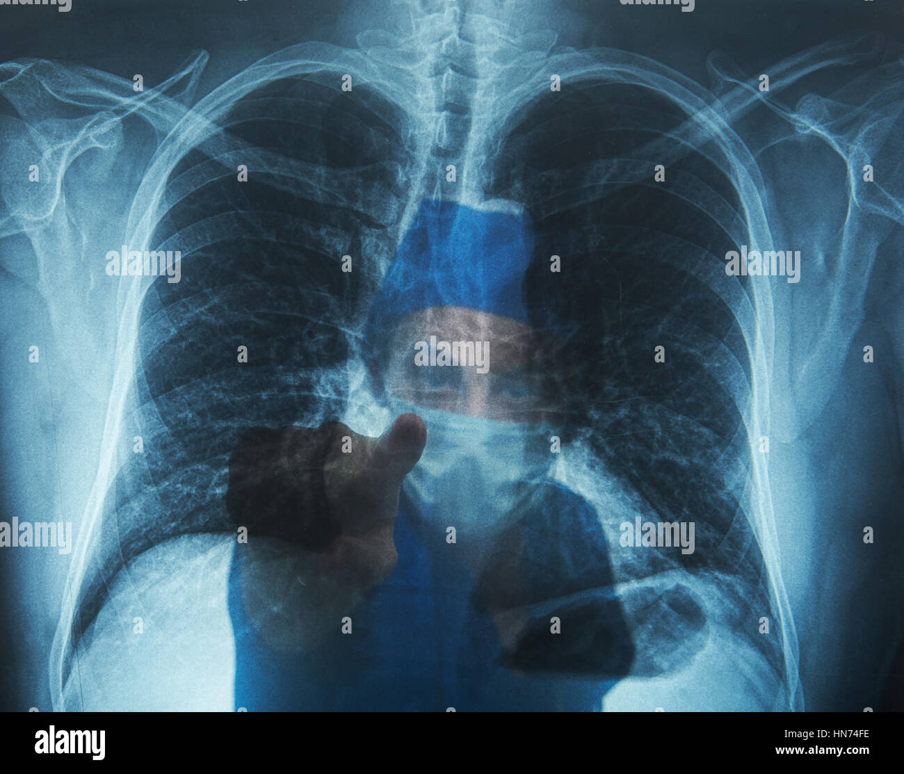 Medico puntando con il dito su polmoni immagine a raggi x Foto Stock
