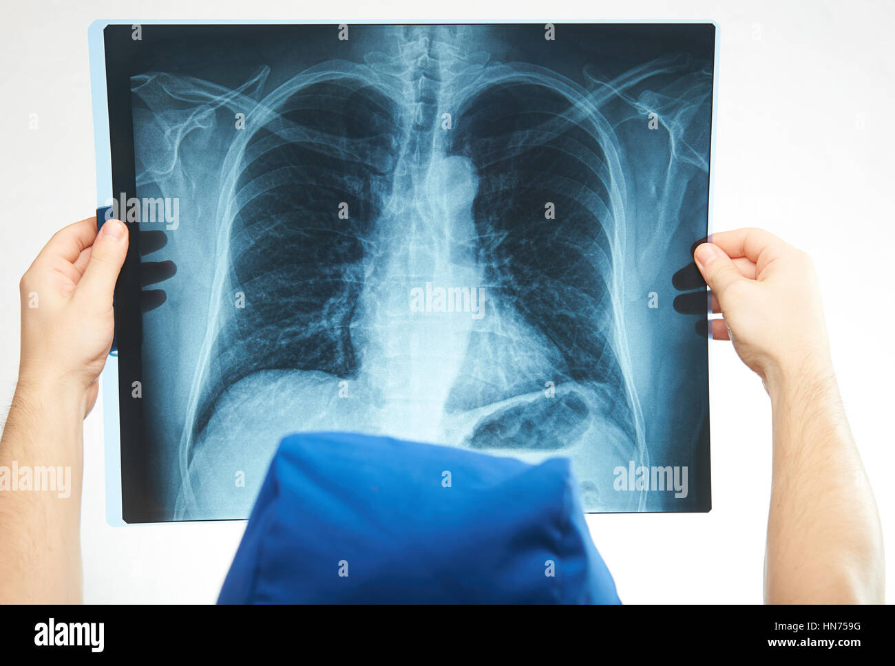 Immagine a raggi x dei polmoni in mano di infermiera isolato su bianco Foto Stock