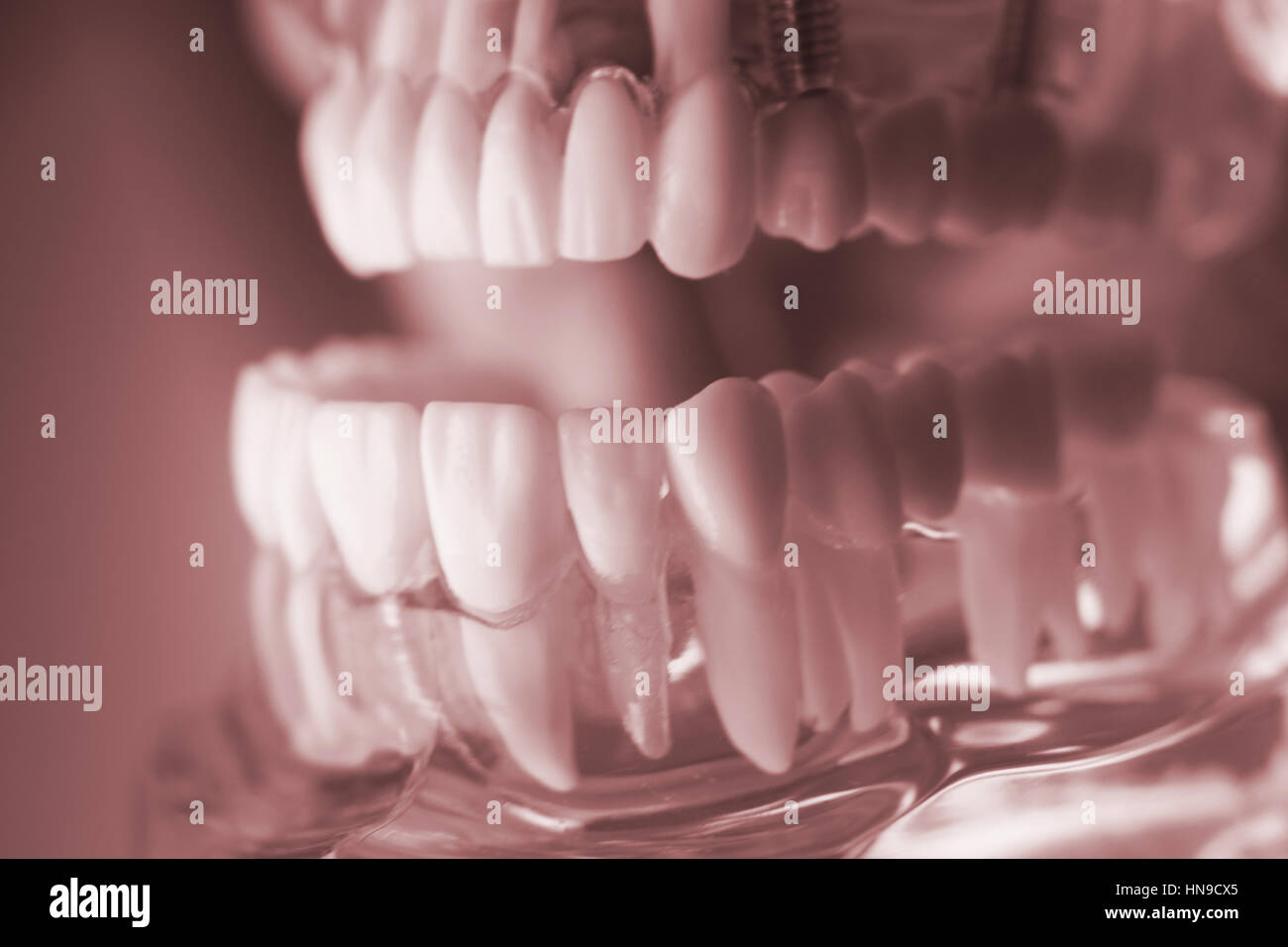 Sarini Modello Dentale Studio Comparativo Carie - Anatomia Dente Per Dentisti E Studenti