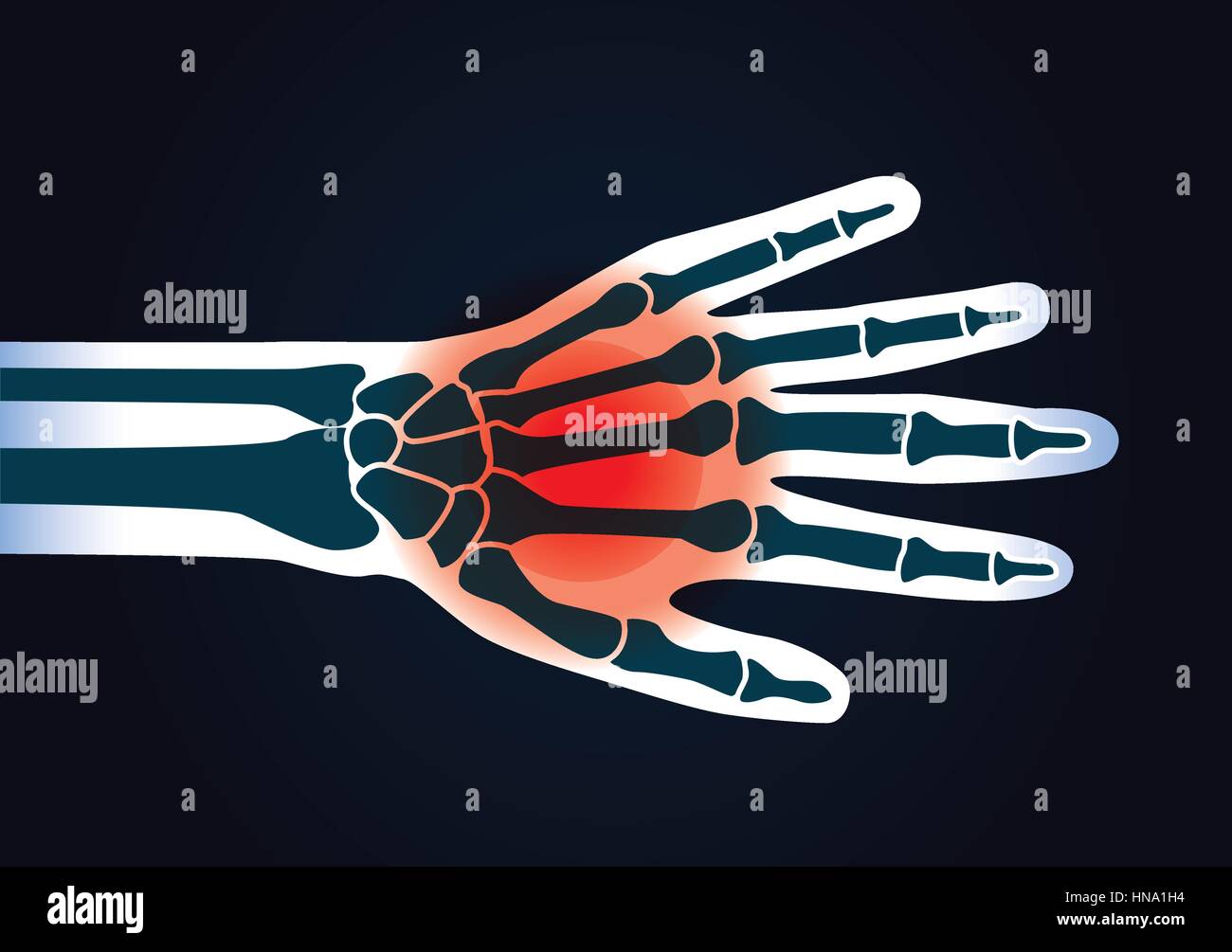 Mano umana osso hanno un segnale rosso. Questa illustrazione circa il dolore del piede. Illustrazione Vettoriale