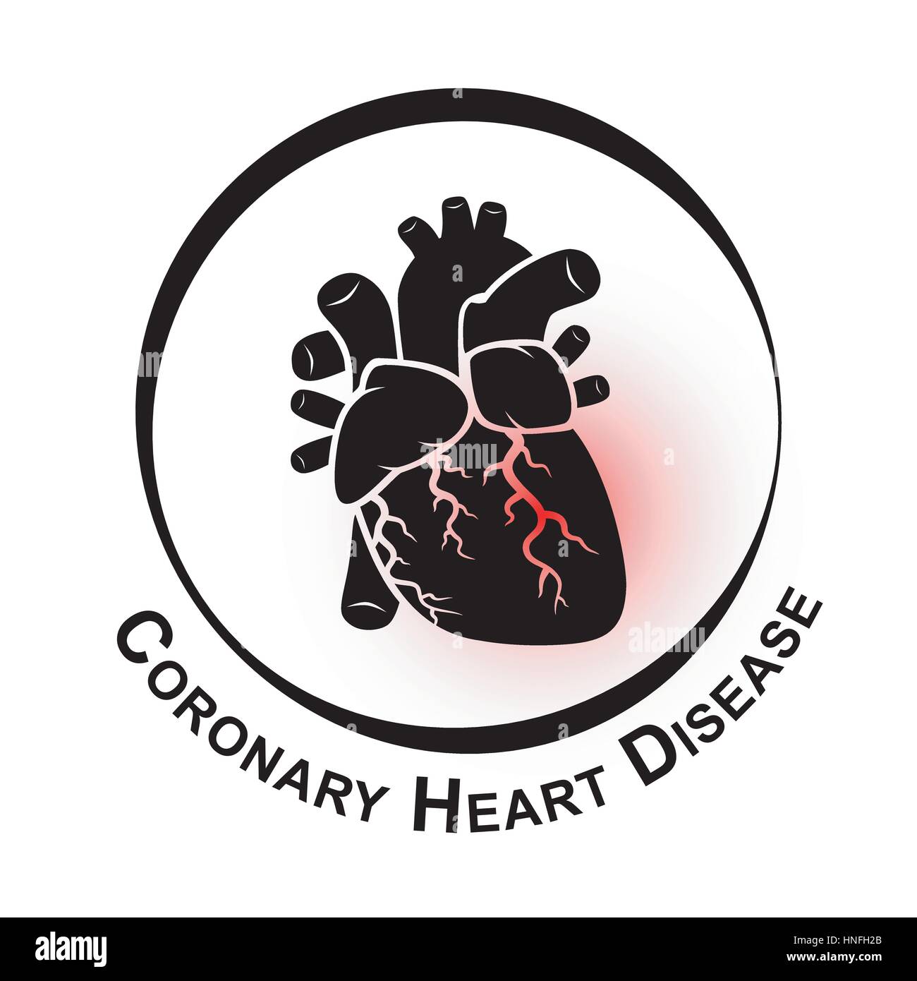 La malattia di cuore coronarica simbolo ( malattia cardiaca ischemica, infarto del miocardio ) area rossa in corrispondenza di arteria coronaria ( trombo occludere in arteria coronaria ) Illustrazione Vettoriale