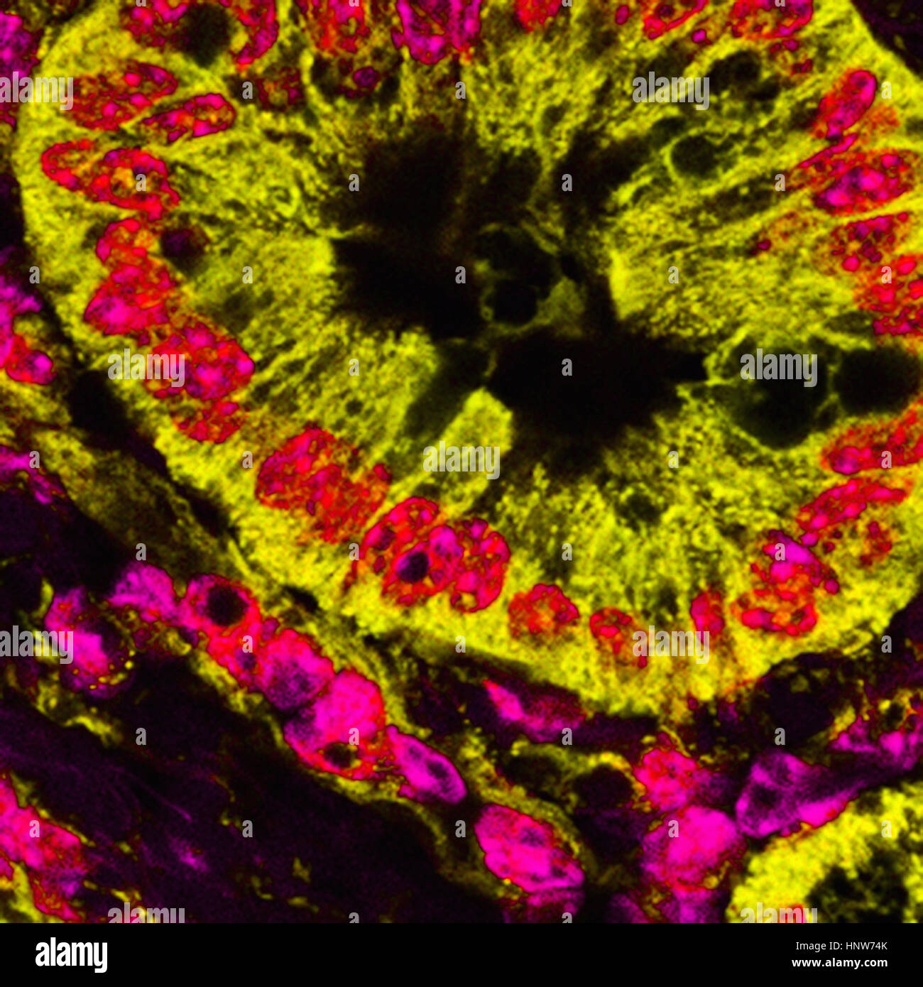 Immagine microscopica di mitocondriale pancreatico macchiato le cellule del cancro Foto Stock