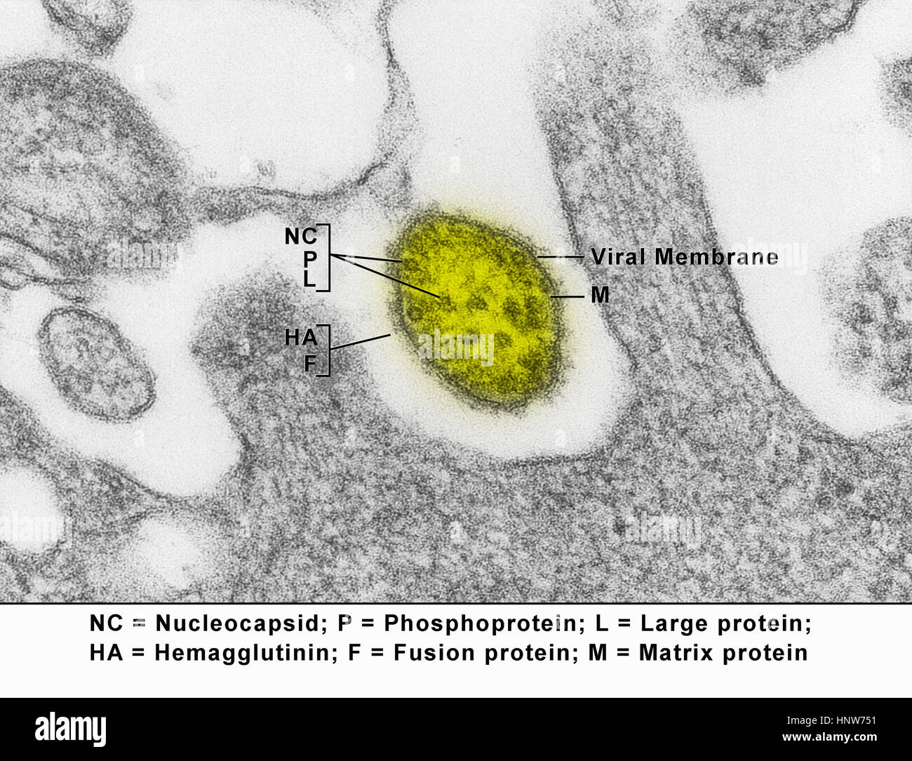 Micrografia elettronica a trasmissione che mostra un virus del morbillo particella, o virione Foto Stock