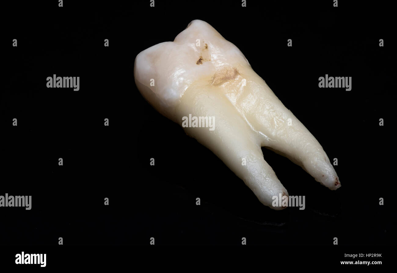 Close-up di dente umano su uno sfondo nero Foto Stock