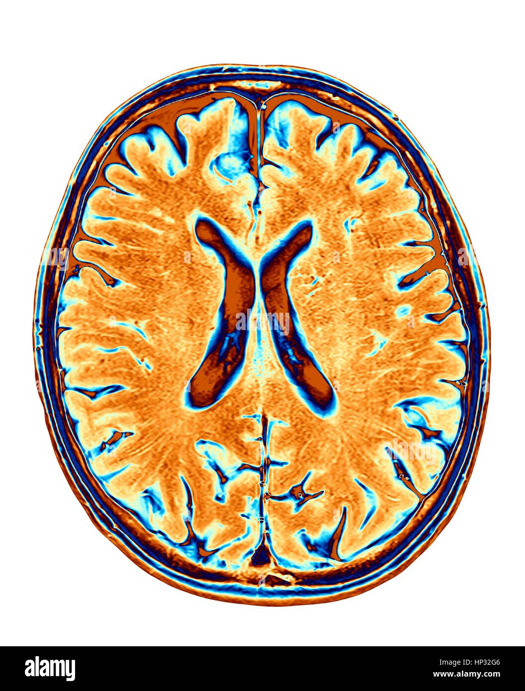 Cervello normale. Colorato di risonanza magnetica (RM) scansione di una sezione assiale attraverso un cervello sano, le immagini mostra la corteccia cerebrale e del ventricolo laterale (X-sagomato in medio). Foto Stock