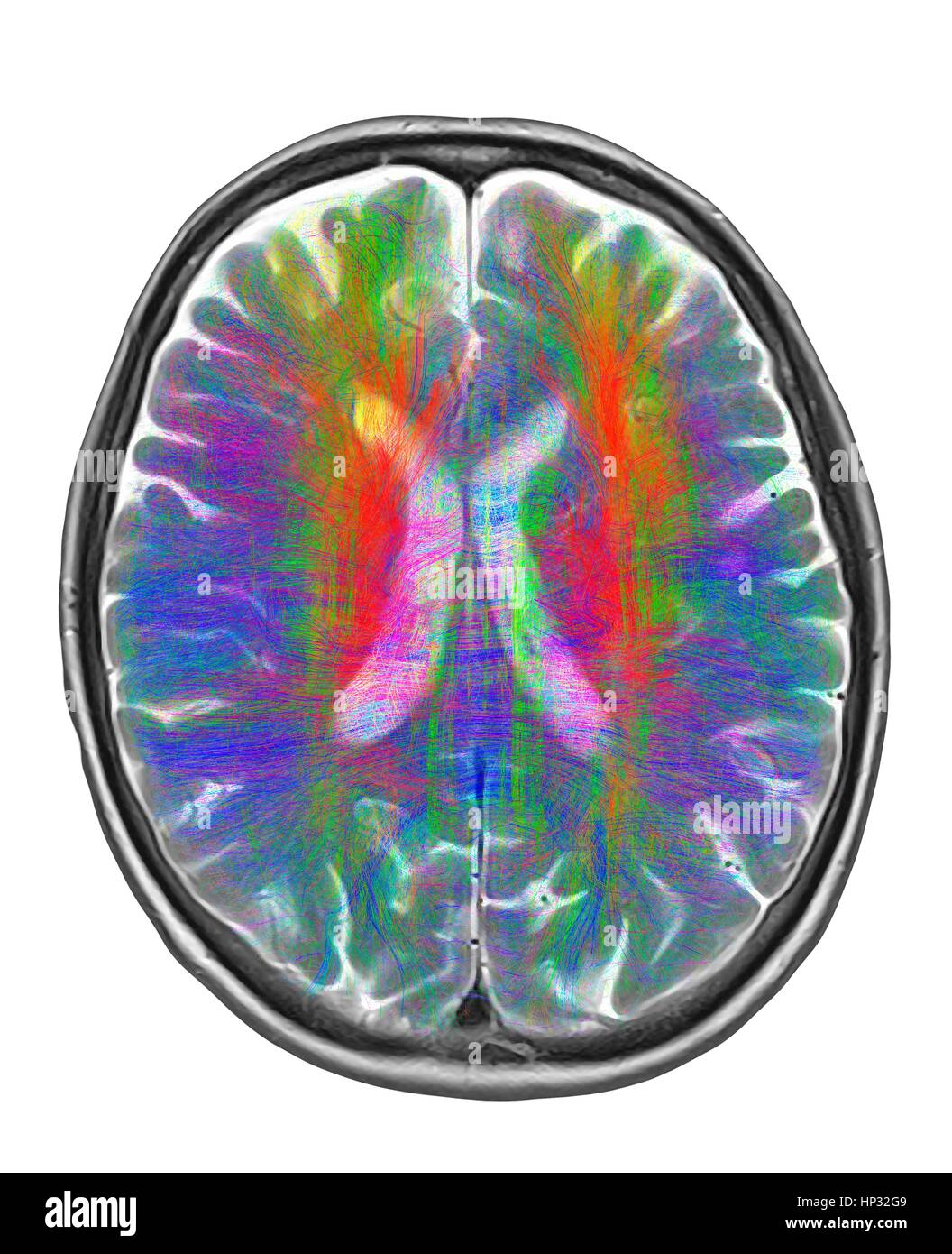 Computer artwork di MRI vista superiore del cervello che mostra la sostanza bianca fibre colorate.3D di diffusione di imaging spettrale (DSI) scansione di fasci di sostanza bianca in fibre di nervo nel cervello.Le fibre la trasmissione dei segnali nervosi tra le regioni del cervello tra cervello midollo spinale.lo spettro di diffusione di imaging (DSI) è una variante del Foto Stock