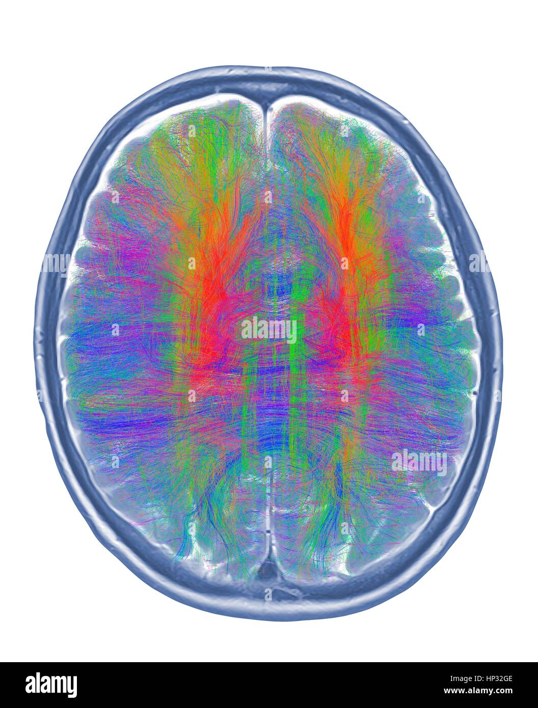 Computer artwork di mri vista superiore del cervello che mostra la sostanza bianca fibre colorate.3D di diffusione di imaging spettrale (DSI) scansione di fasci di sostanza bianca in fibre di nervo nel cervello.Le fibre la trasmissione dei segnali nervosi tra le regioni del cervello tra cervello midollo spinale.lo spettro di diffusione di imaging (DSI) è una variante del Foto Stock