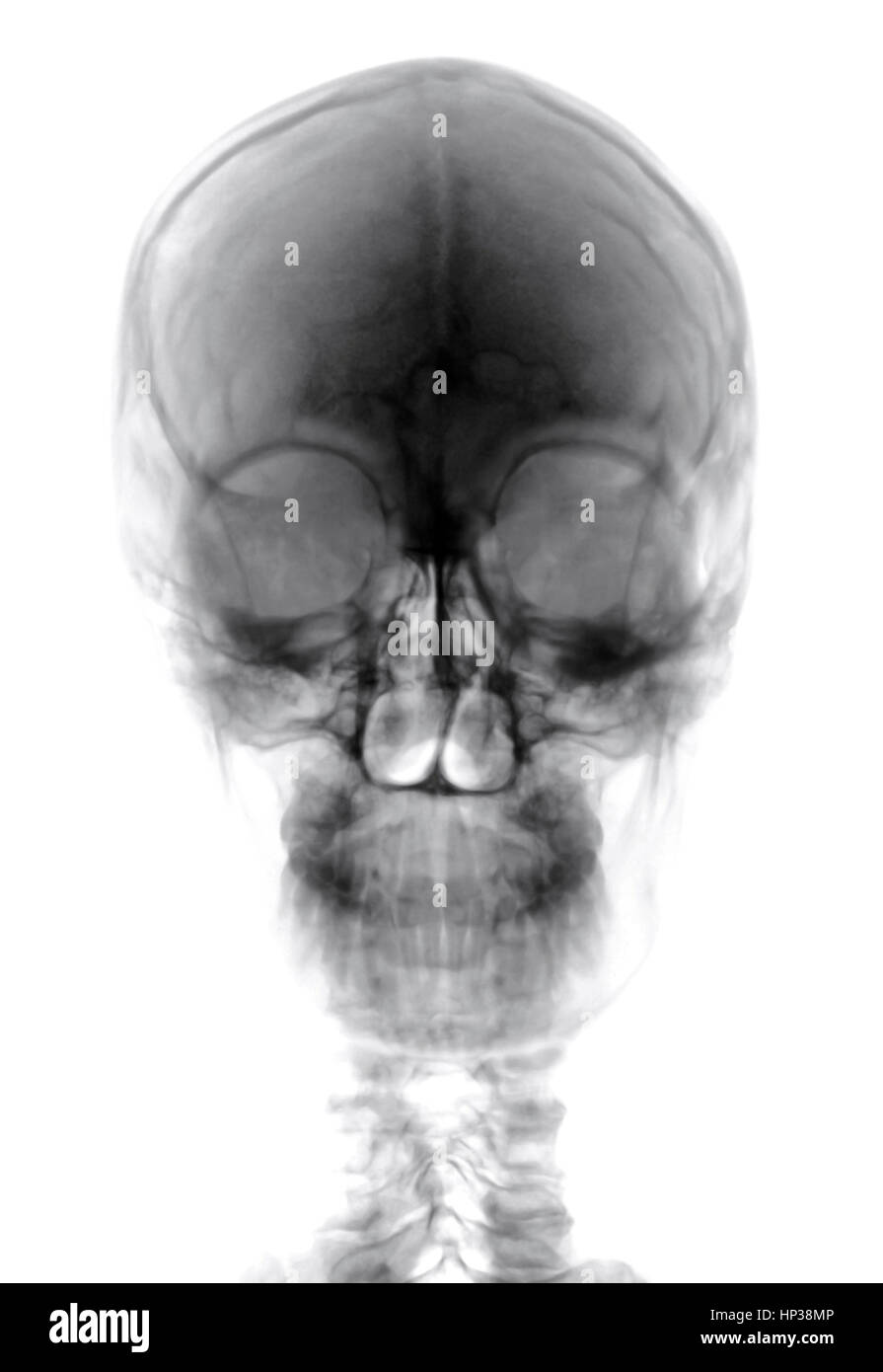 Testa umana sul bianco e nero pellicola a raggi x Foto Stock
