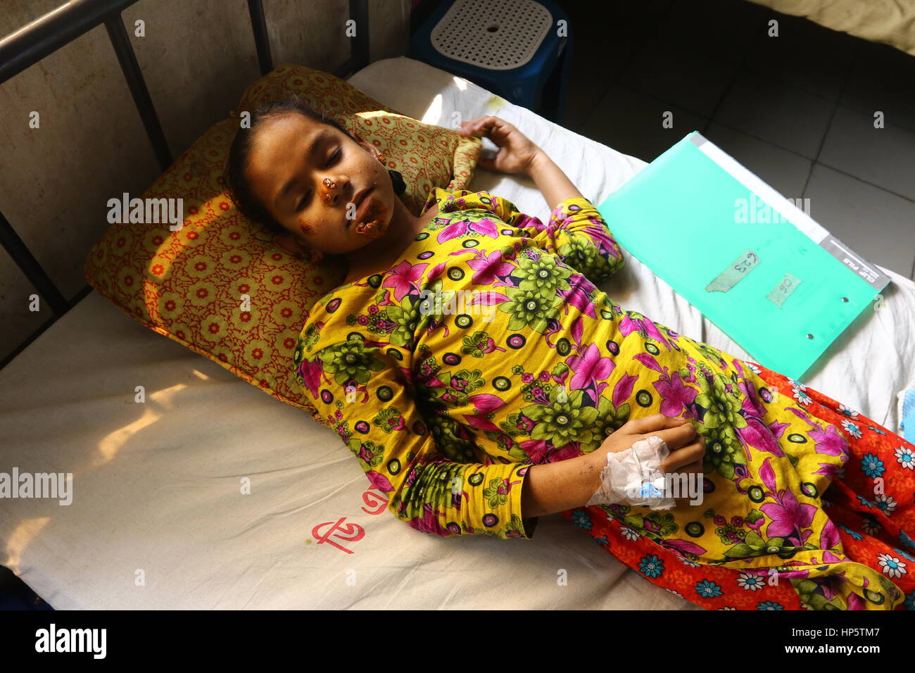 Dacca in Bangladesh 19 febbraio 2017. Shahana Khatun, dieci-anno-vecchia ragazza, si siede sul letto di ospedale dopo la chirurgia per il viso, il naso e le orecchie a Dhaka Medical College Hospital di Dhaka, Bangladesh 19 febbraio 2017. I medici fecero il successo di un intervento chirurgico su 07 Febbraio e spero che lei sarà fine entro pochi mesi Mentre Shahana fu ammesso all'ospedale con corteccia-come verruche e eruzioni cutanee sul suo viso, i sintomi di una rara malattia della pelle chiamato "albero-uomo sindrome. Foto Stock