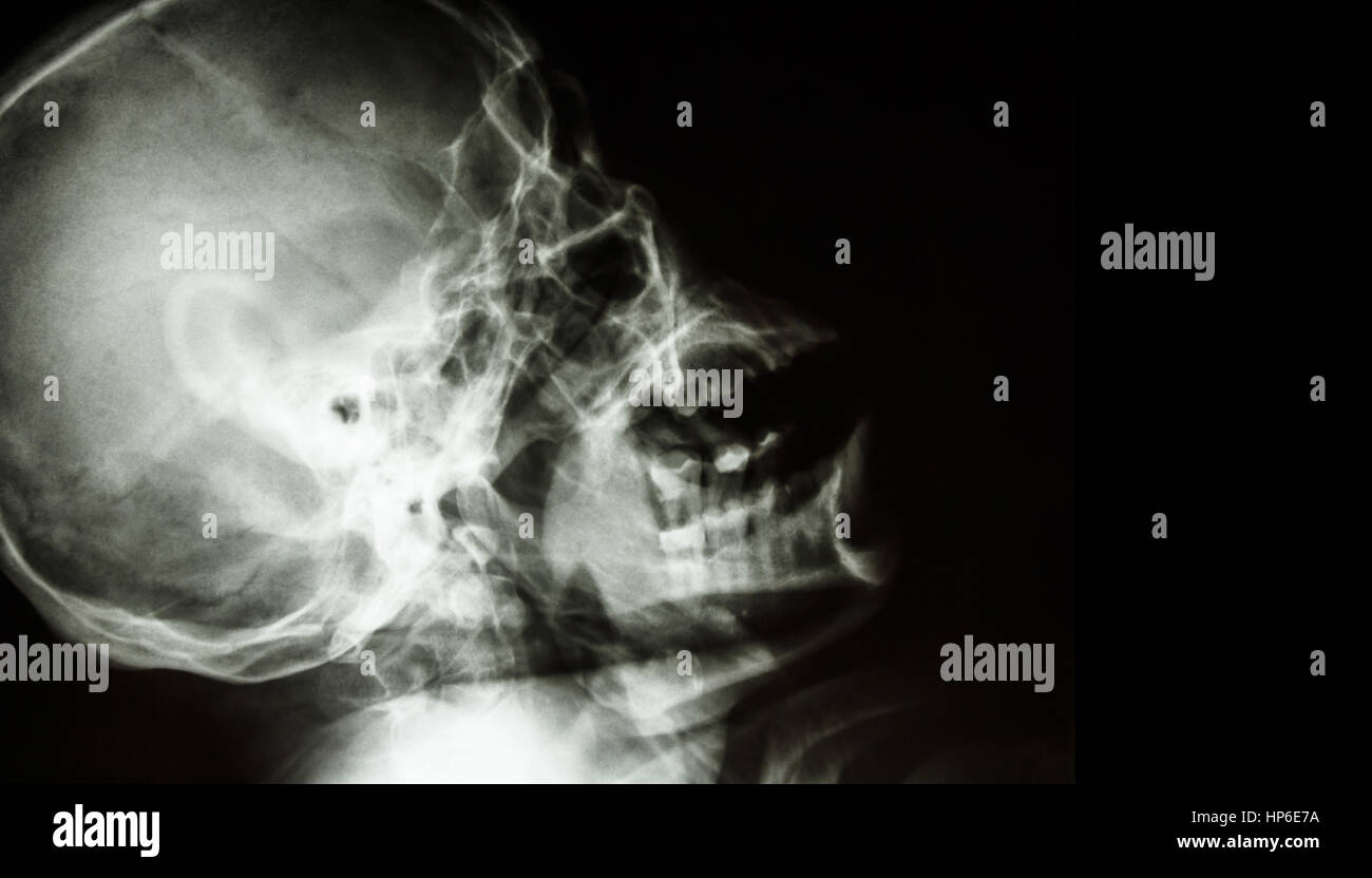 Film X-ray di normale teschio umano . vista laterale . La zona vuota a destra . Foto Stock