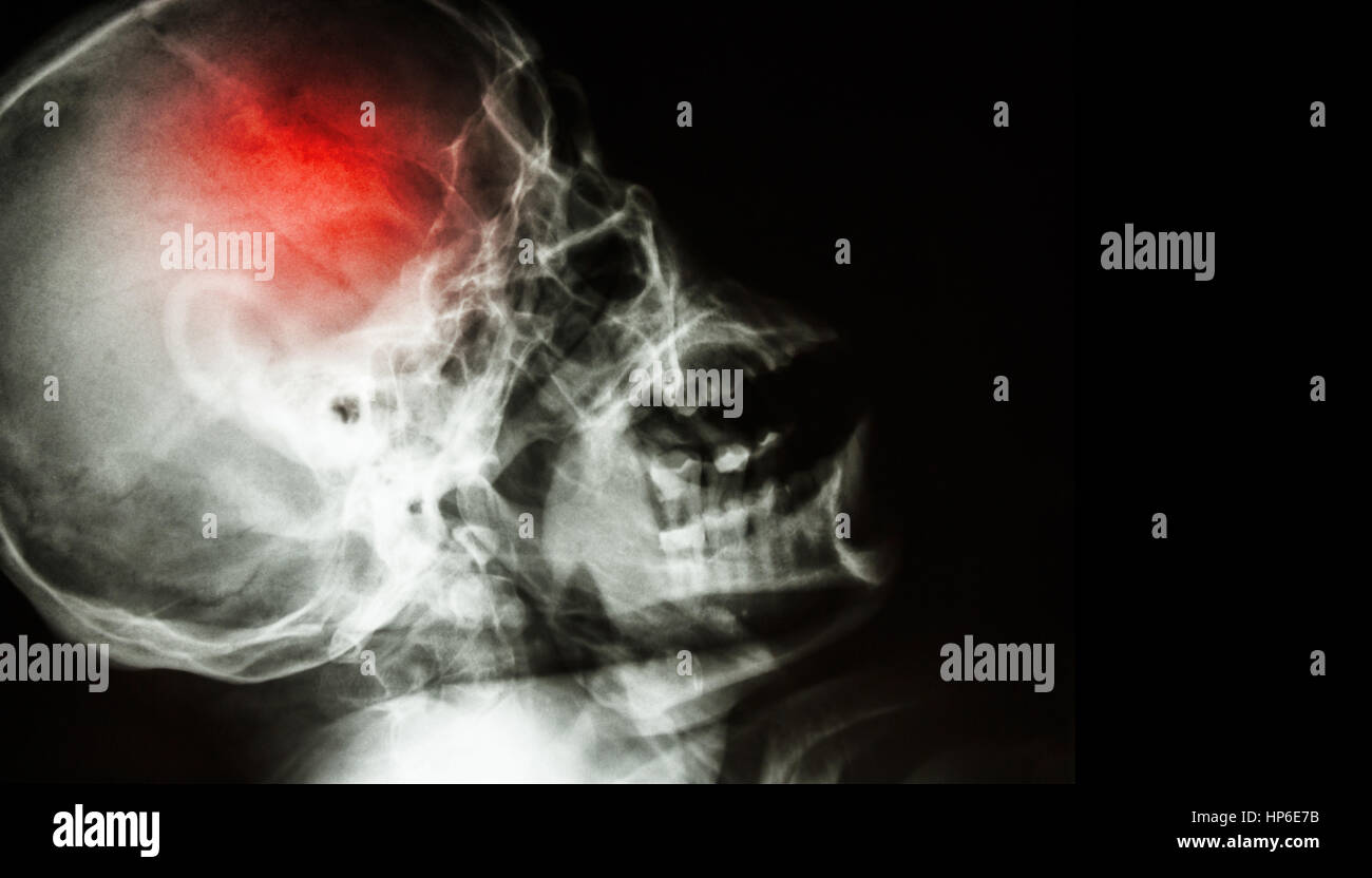 Stroke . il film x-ray del teschio umano vista laterale con corsa . La zona vuota a destra . Foto Stock