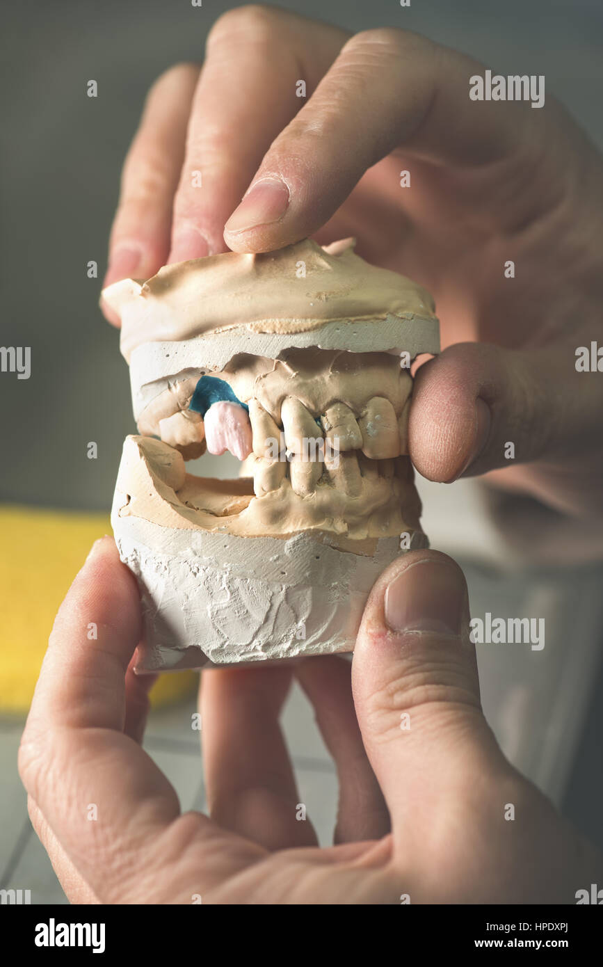 Protesi dentale, dente artificiale di protesi, mani lavorando sulla dentiera, denti finti. Foto Stock