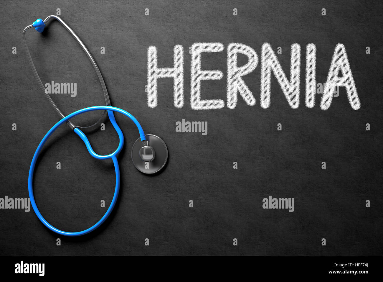 Concetto medico: ernia manoscritta su lavagna. Vista dall'alto di uno stetoscopio blu sulla lavagna. Lavagna nera con ernia - concetto medico. 3 Foto Stock