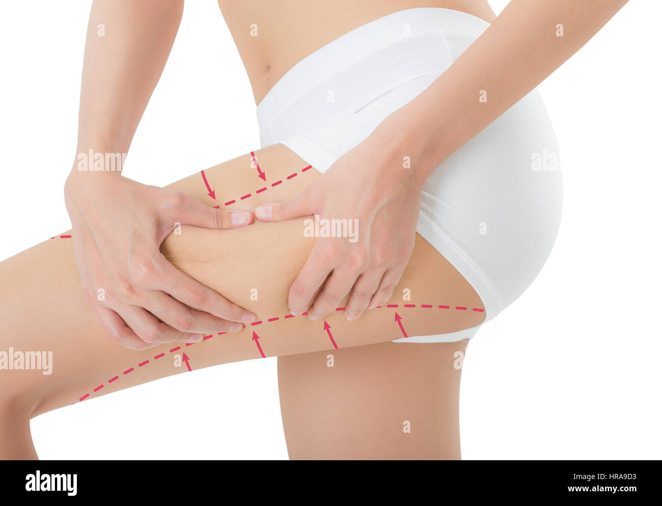 Donna afferrando la pelle sulla sua coscia con il disegno frecce rosse, perdere peso e liposuzione cellulite distacco concetto, isolati su sfondo bianco. Foto Stock