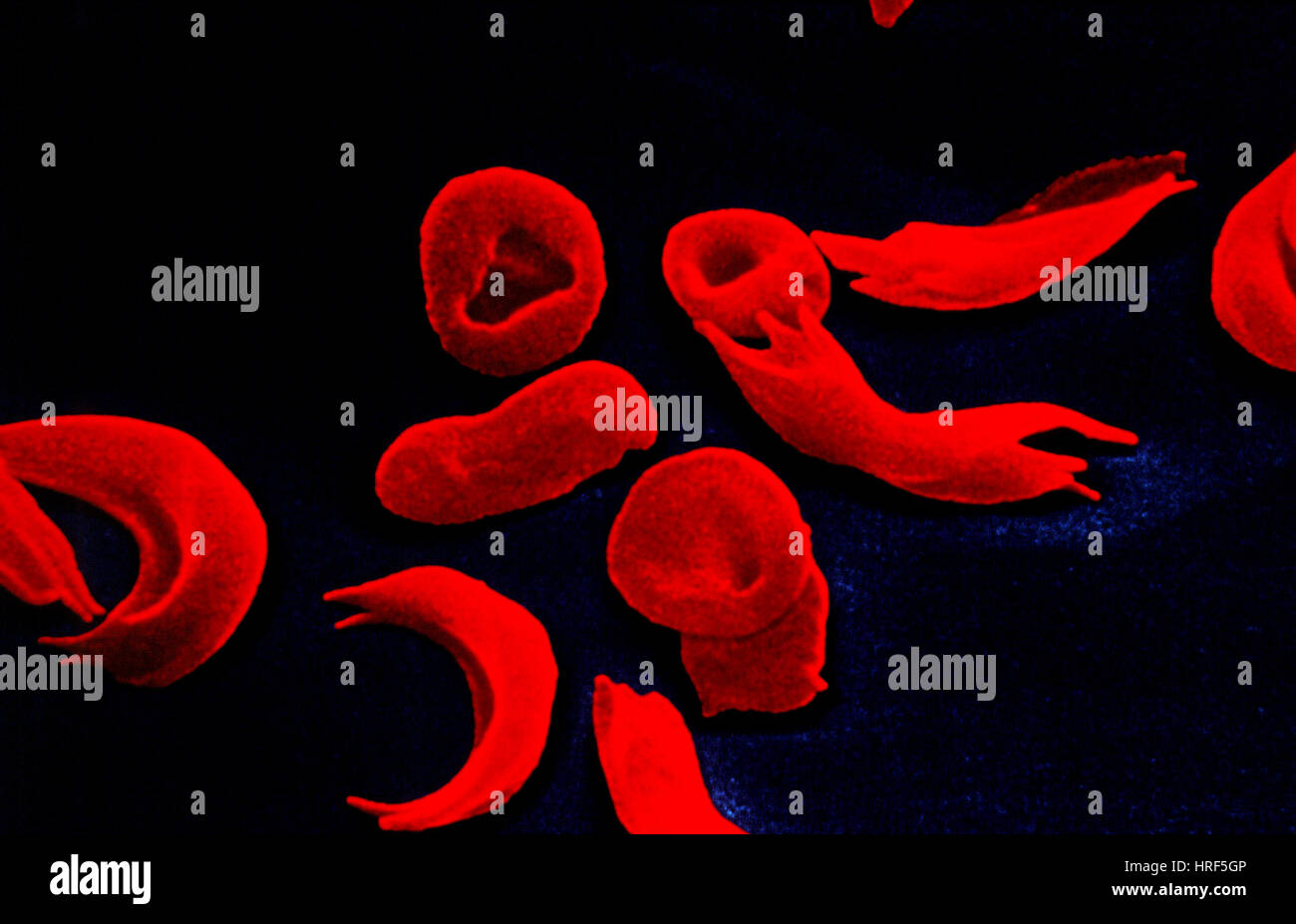 SEM di sangue in anemia falciforme Foto Stock