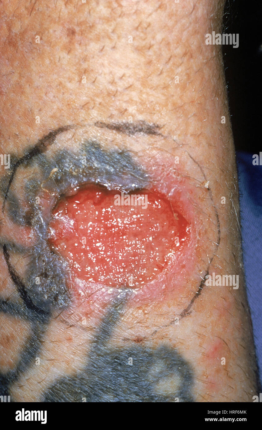 Il Carcinoma a cellule basali Foto Stock